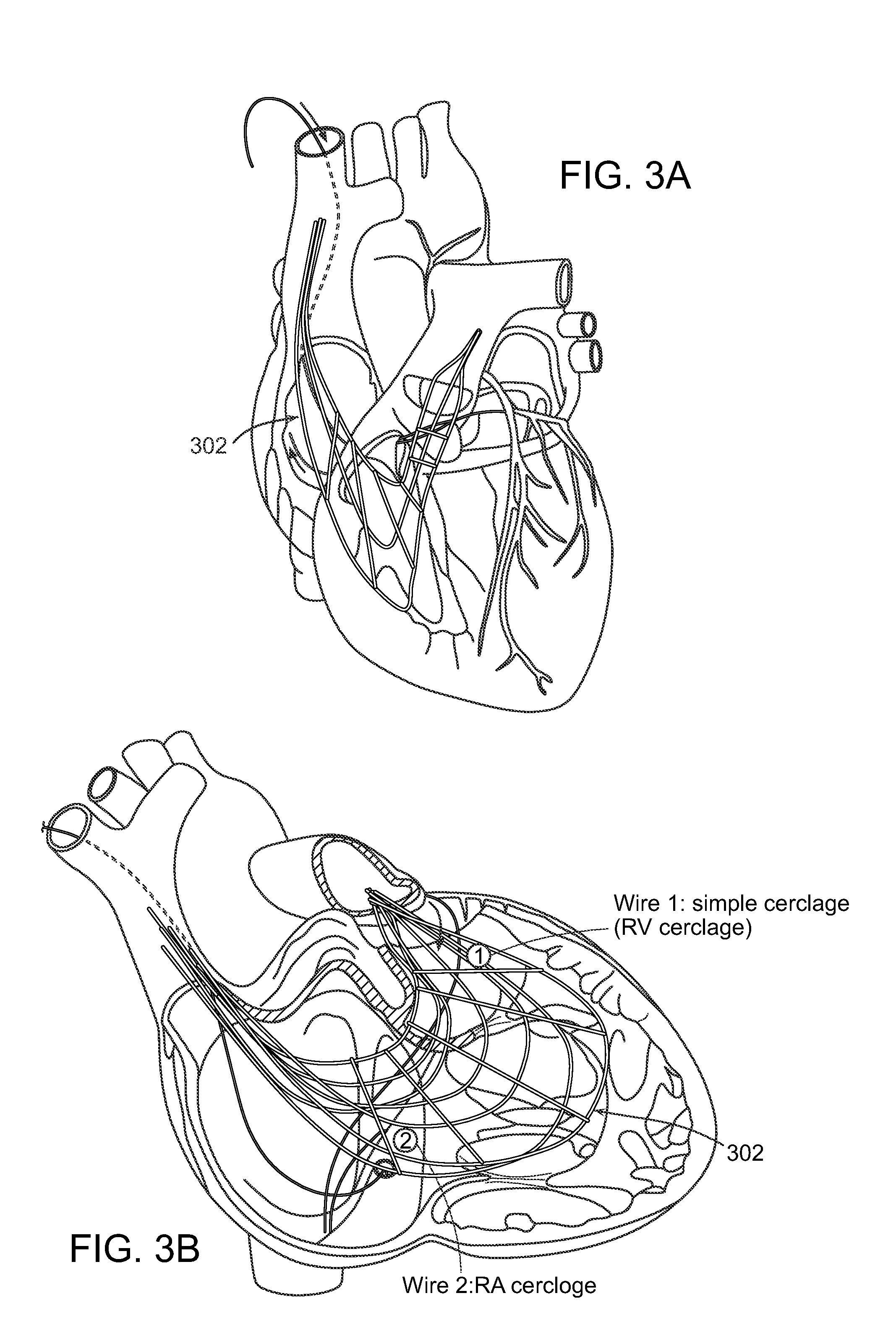 Methods and devices for transcatheter cerclage annuloplasty