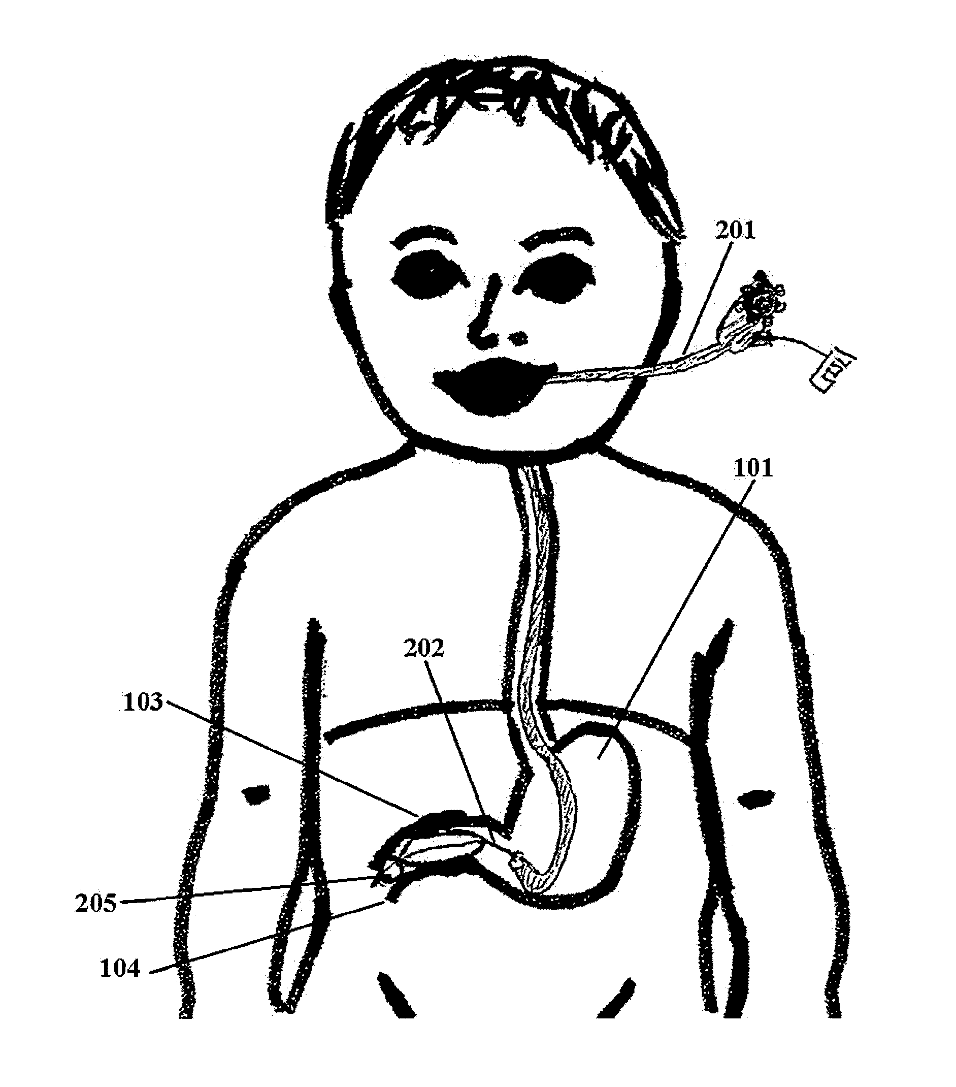 Endopyloric tool and method to treat hypertropic pyloric stenosis