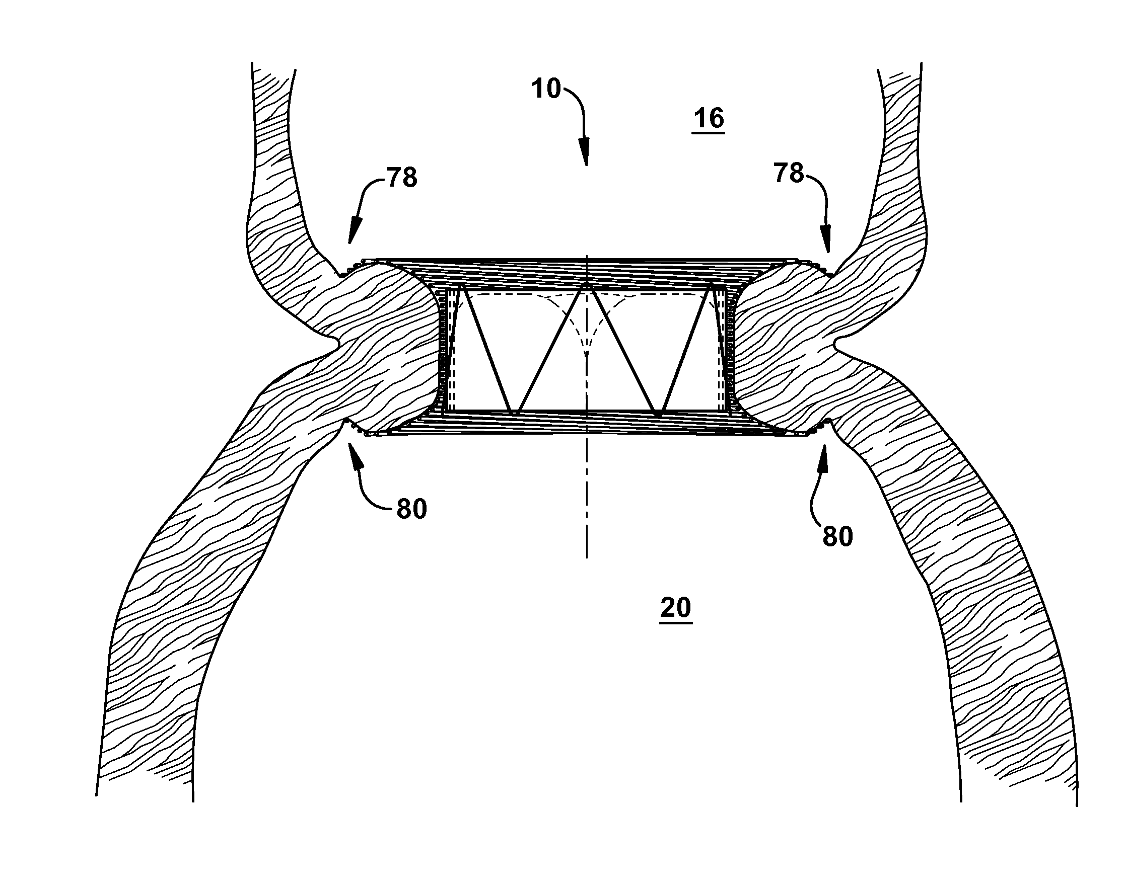 Apparatus and method for replacing a diseased cardiac valve