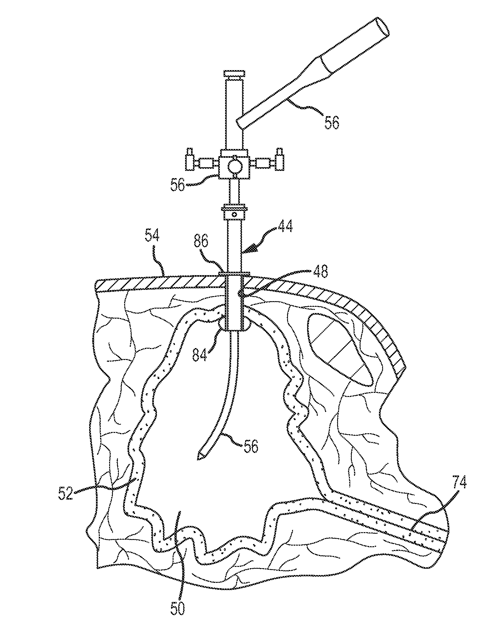 Method and Apparatus for Placing a Cannula in a Bladder