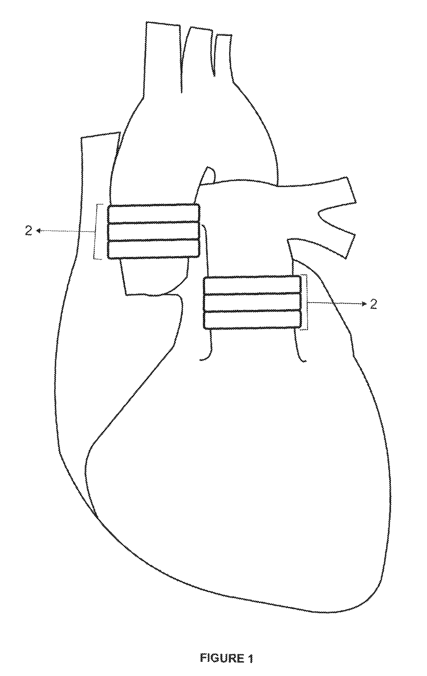 Endovascular heart assist device