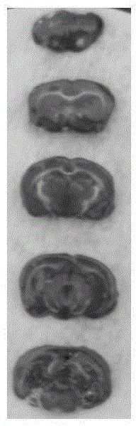 Medicine and composition for treating cerebral ischemic diseases