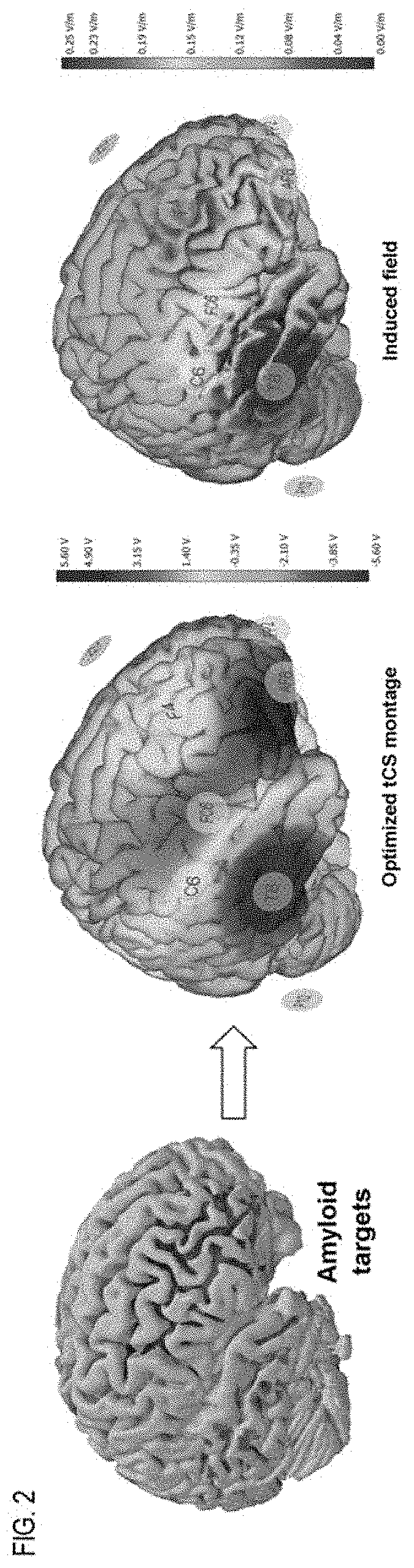 Systems and methods for treating brain disease using targeted neurostimulation