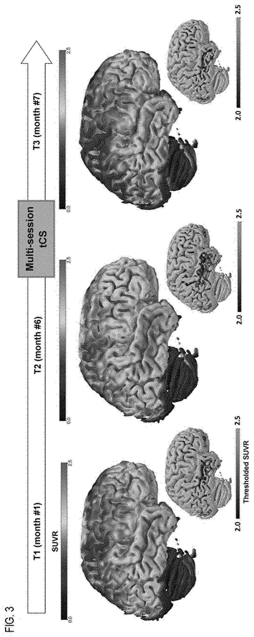 Systems and methods for treating brain disease using targeted neurostimulation