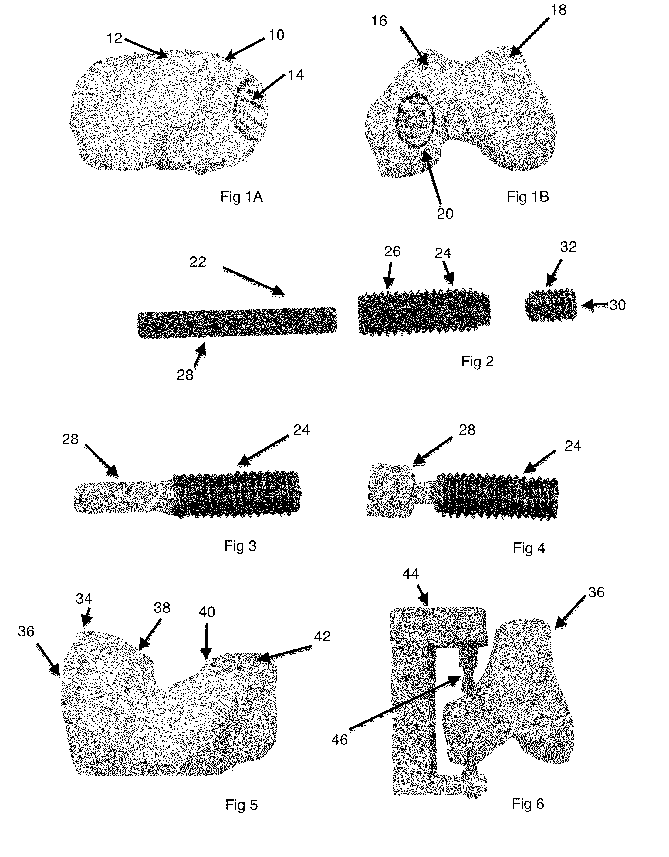 System and method for joint restoration by extracapsular means