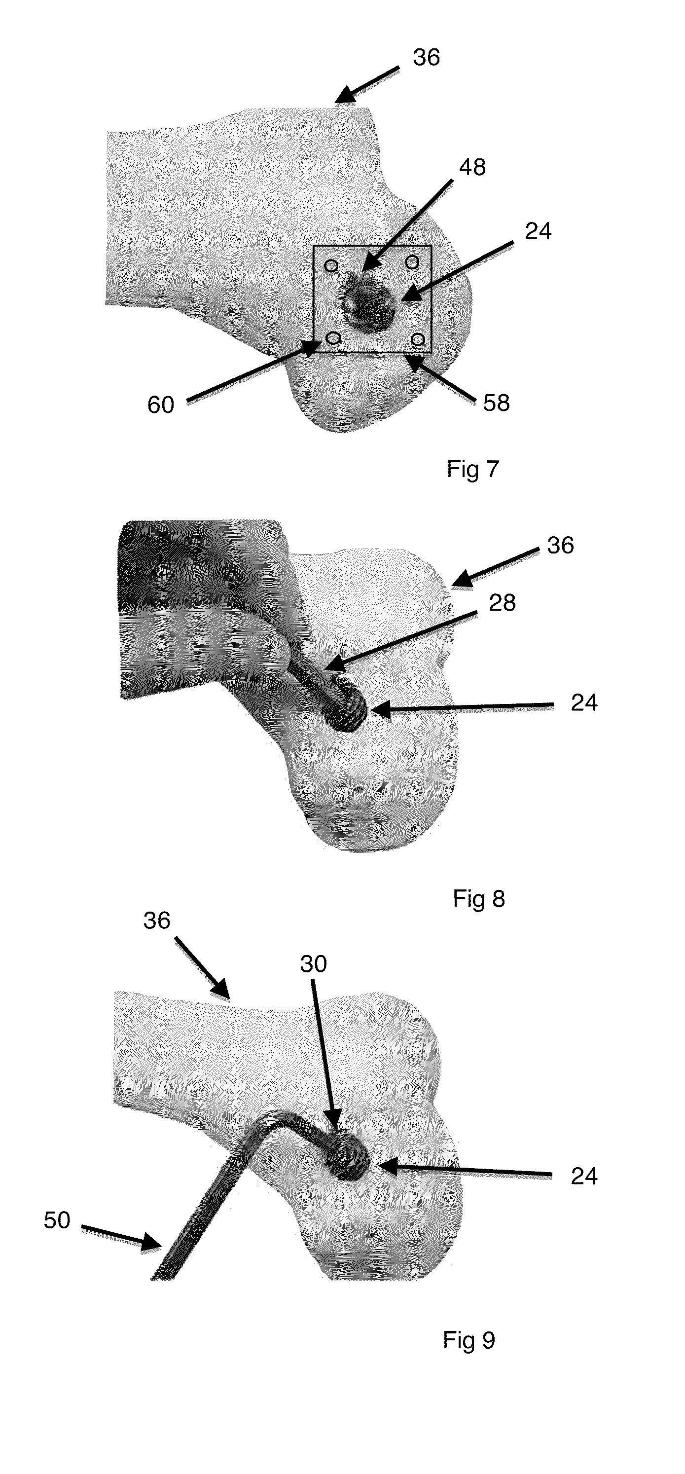 System and method for joint restoration by extracapsular means