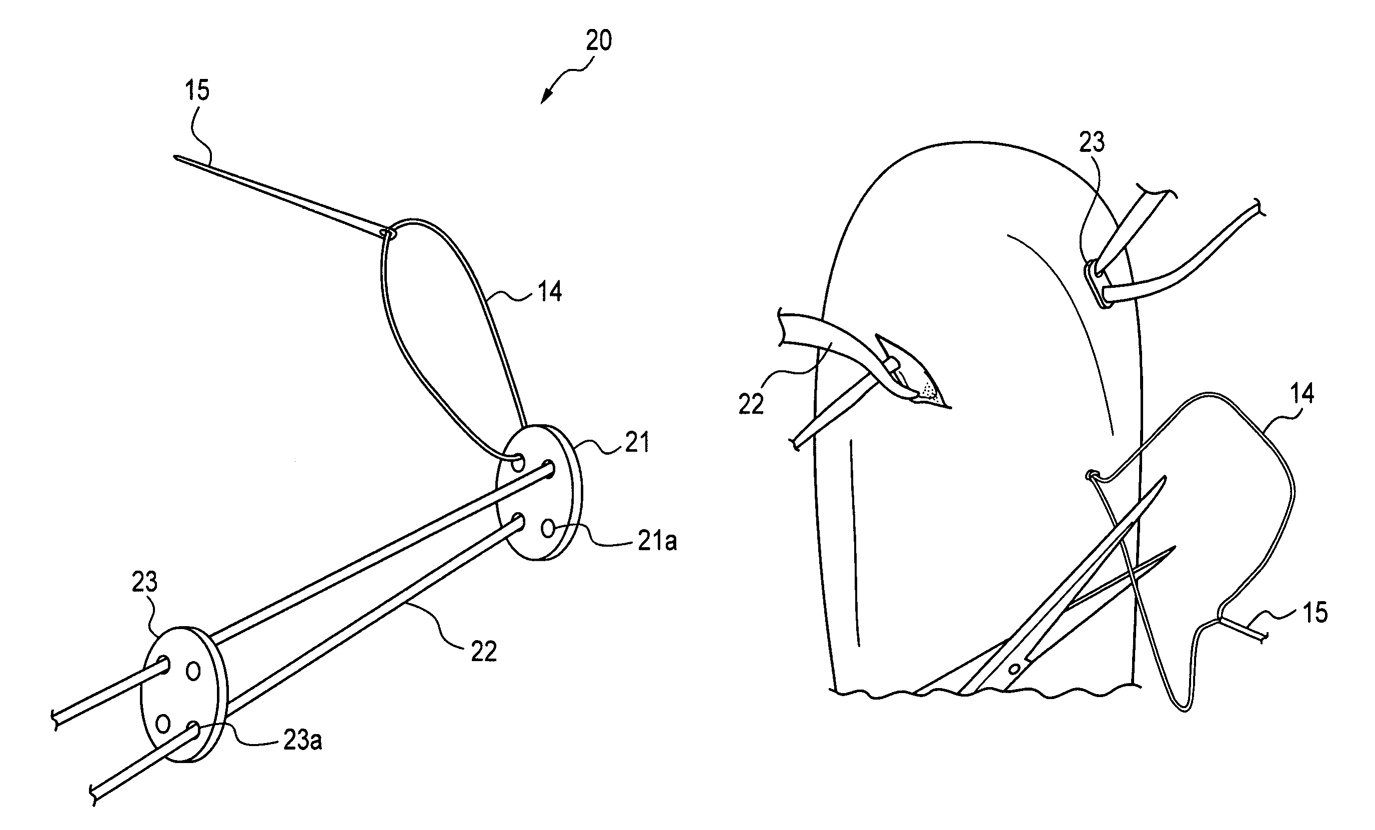 Method and suture-button construct for stabilization of cranial cruciate ligament deficient stifle