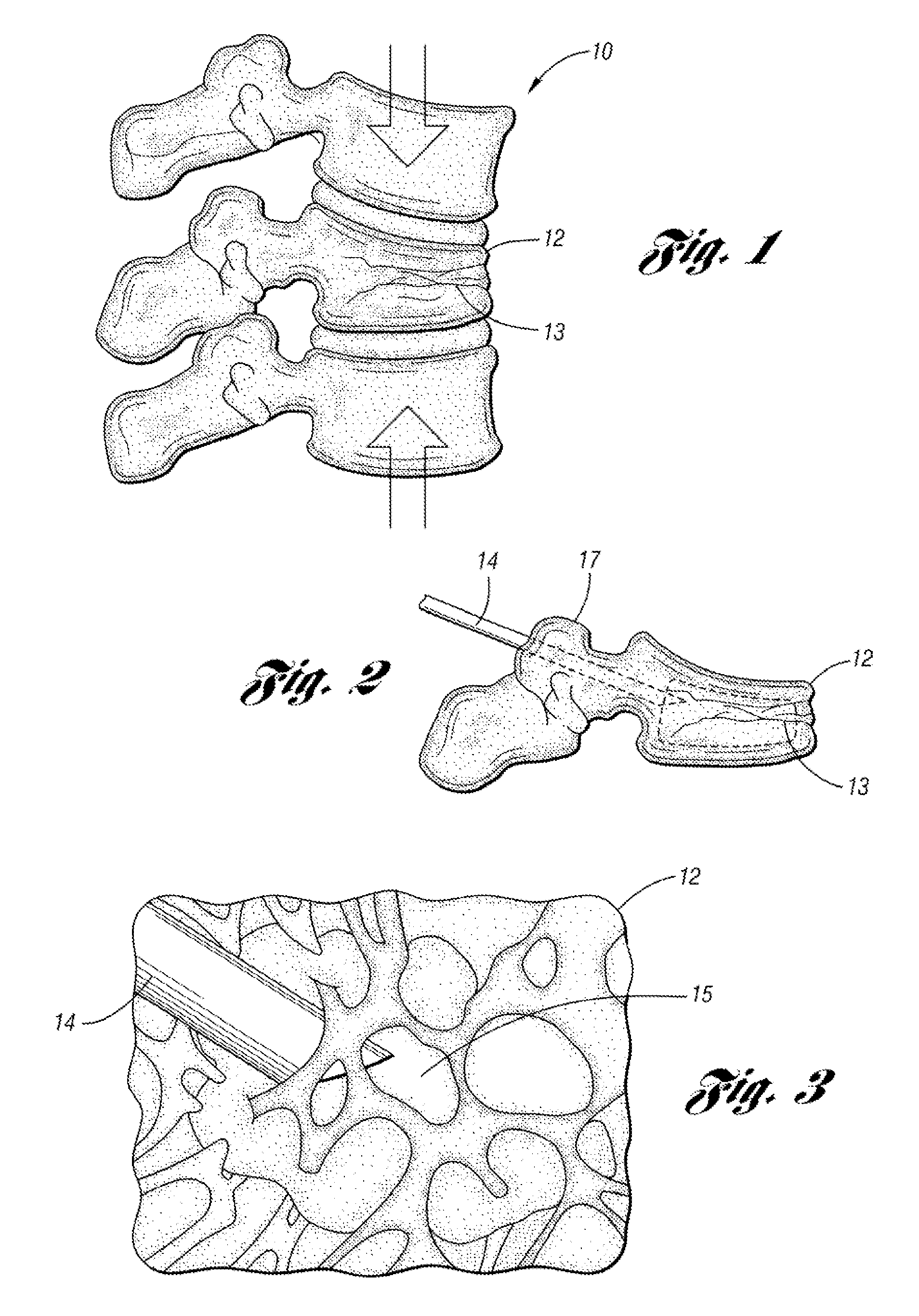 Bone cement mixing and delivery device and method of use