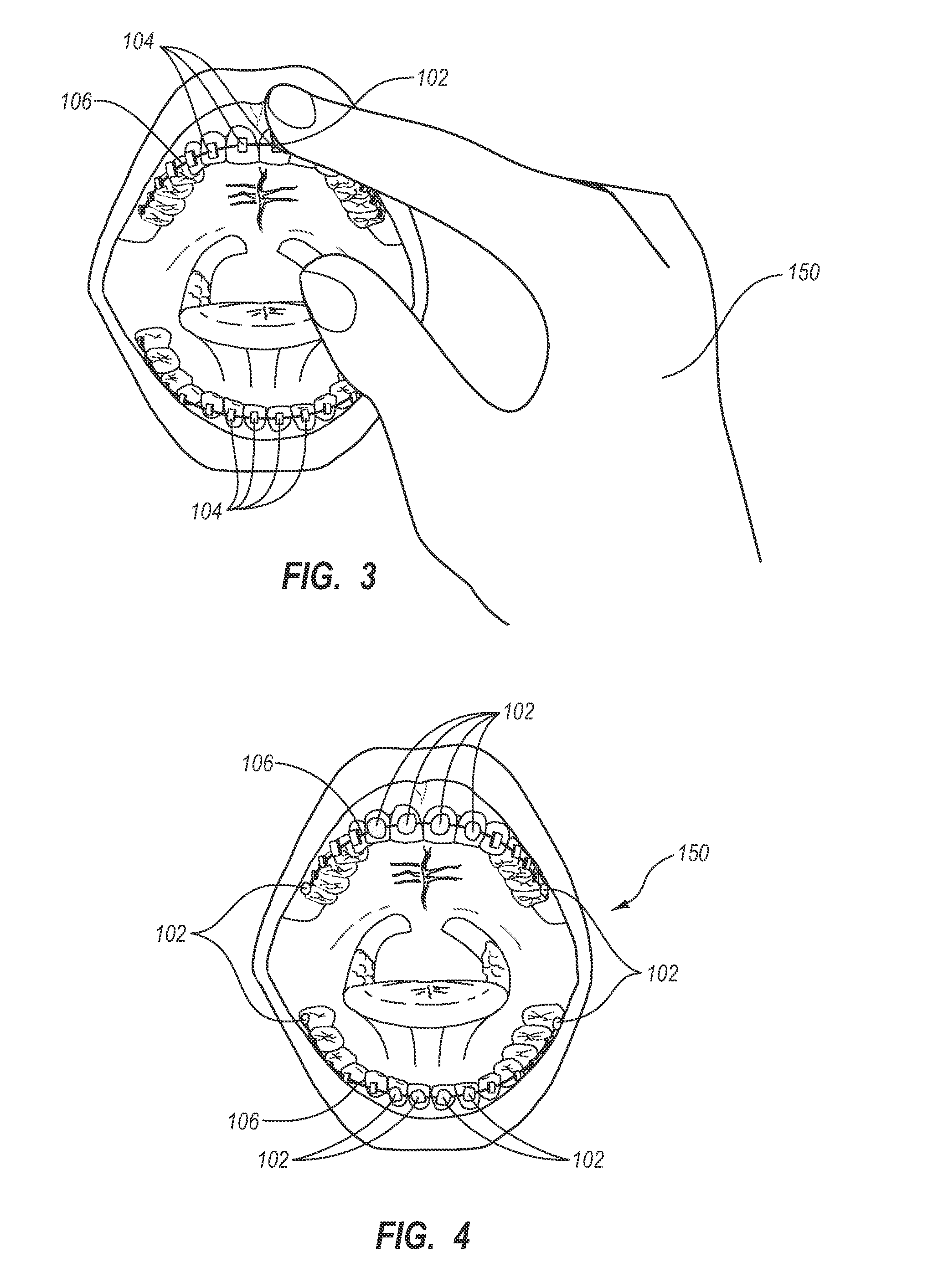 Polymerizable temporary coating methods and systems for intraoral devices