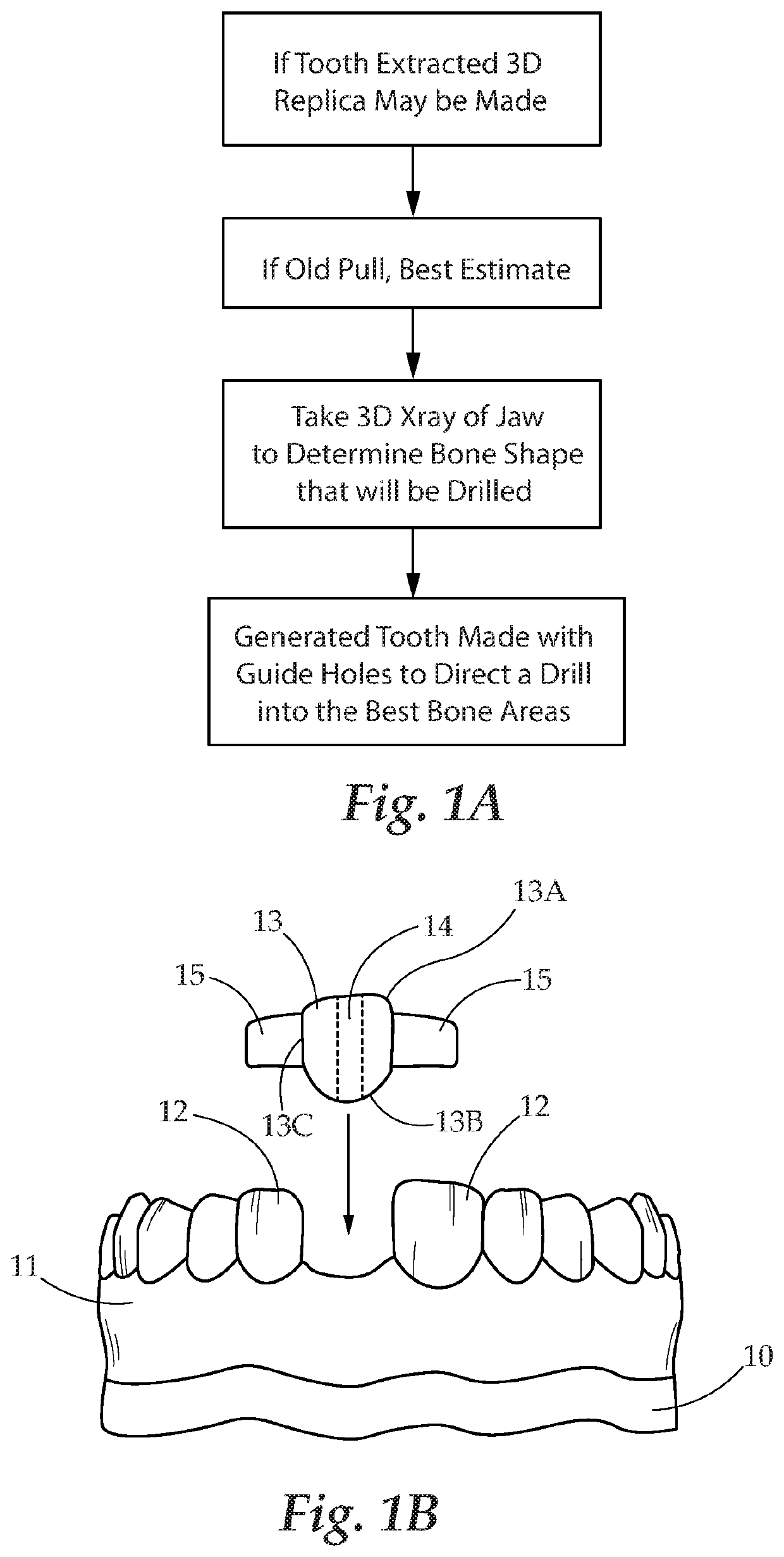 Dental Prosthesis