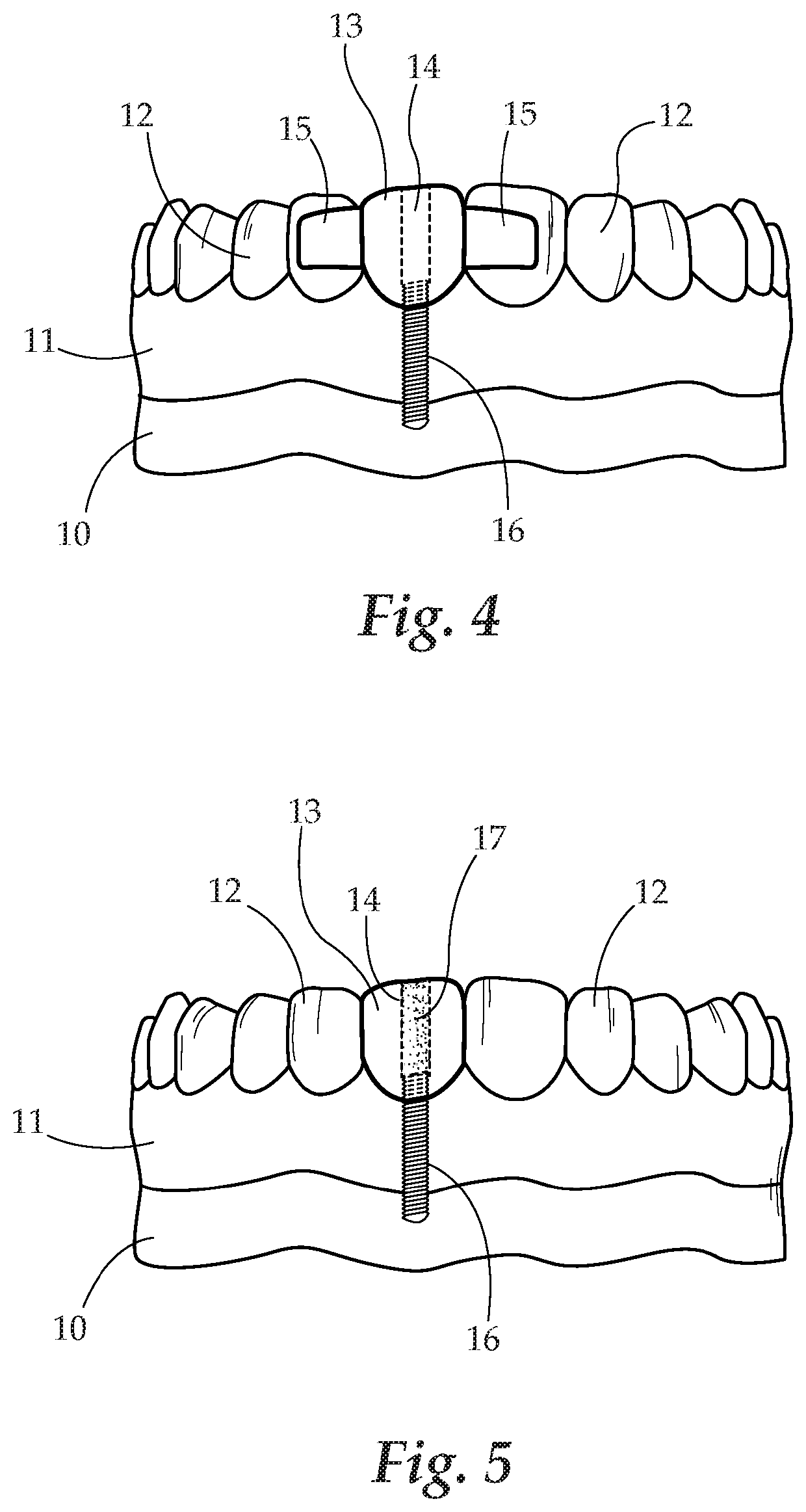 Dental Prosthesis