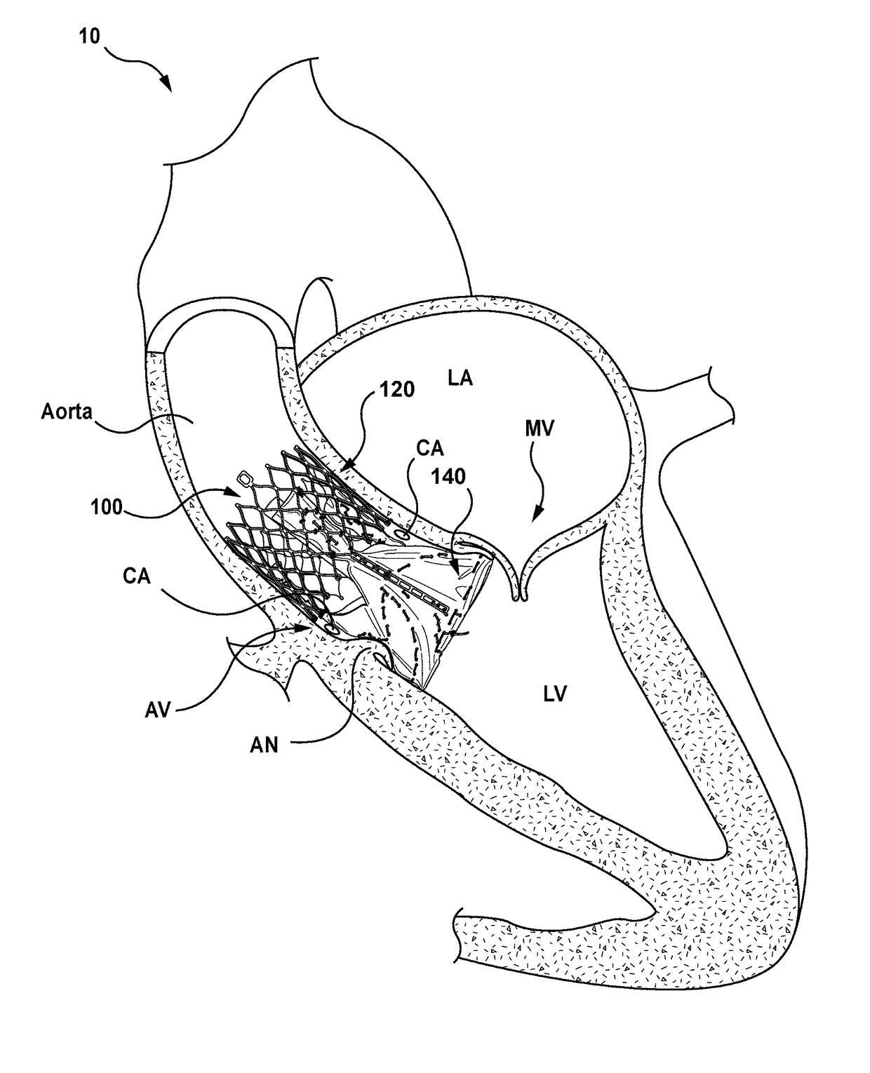 Transcatheter heart valve replacement systems, heart valve prostheses, and methods for percutaneous heart valve replacement