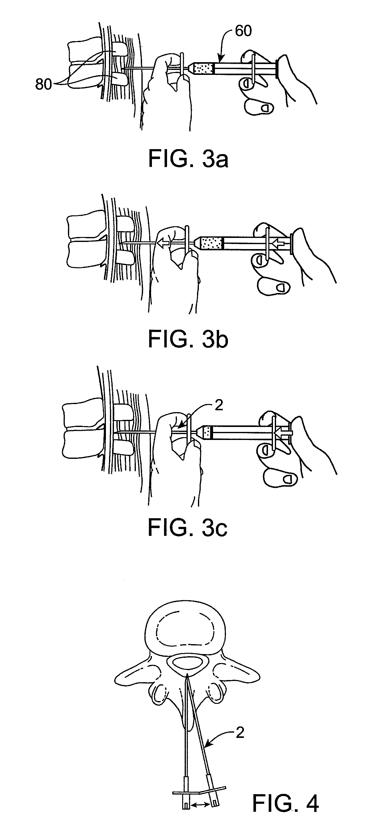Devices and methods for tissue modification