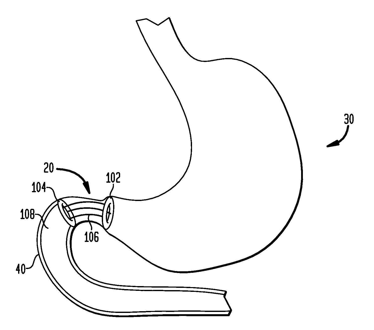 Systems and methods for treatment of obesity and type 2 diabetes