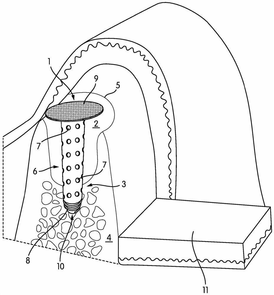 Dental device for ridge preservation and promotion of jaw bone regeneration in an extraction site