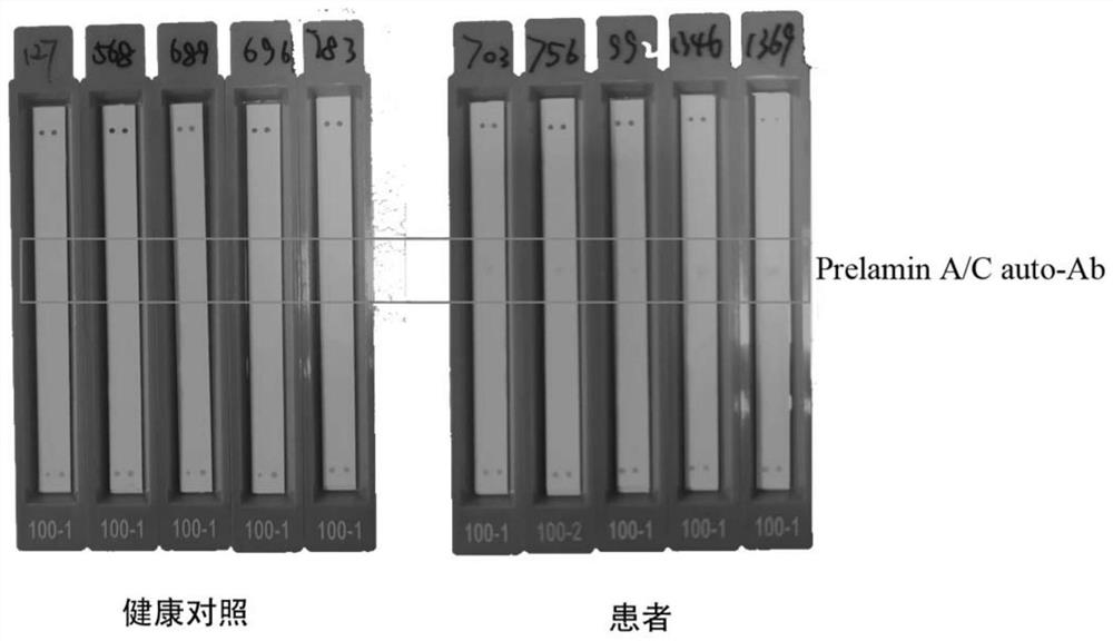 Kit for detecting anti-Pelamin A/C-IgG antibody