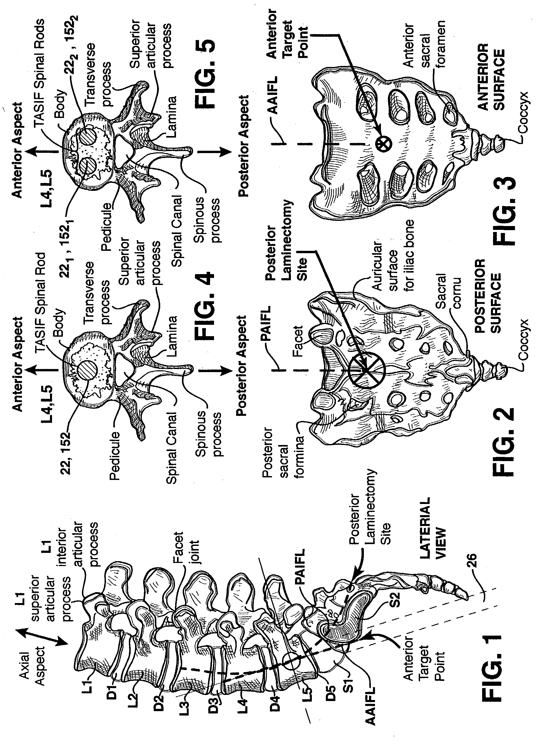 Axial spinal implant and method and apparatus for implanting an axial spinal implant within the vertebrae of the spine