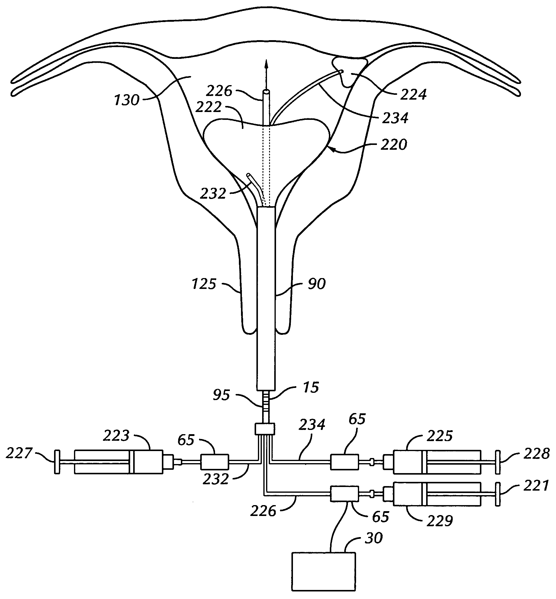 Apparatus and method for selectably treating a fallopian tube