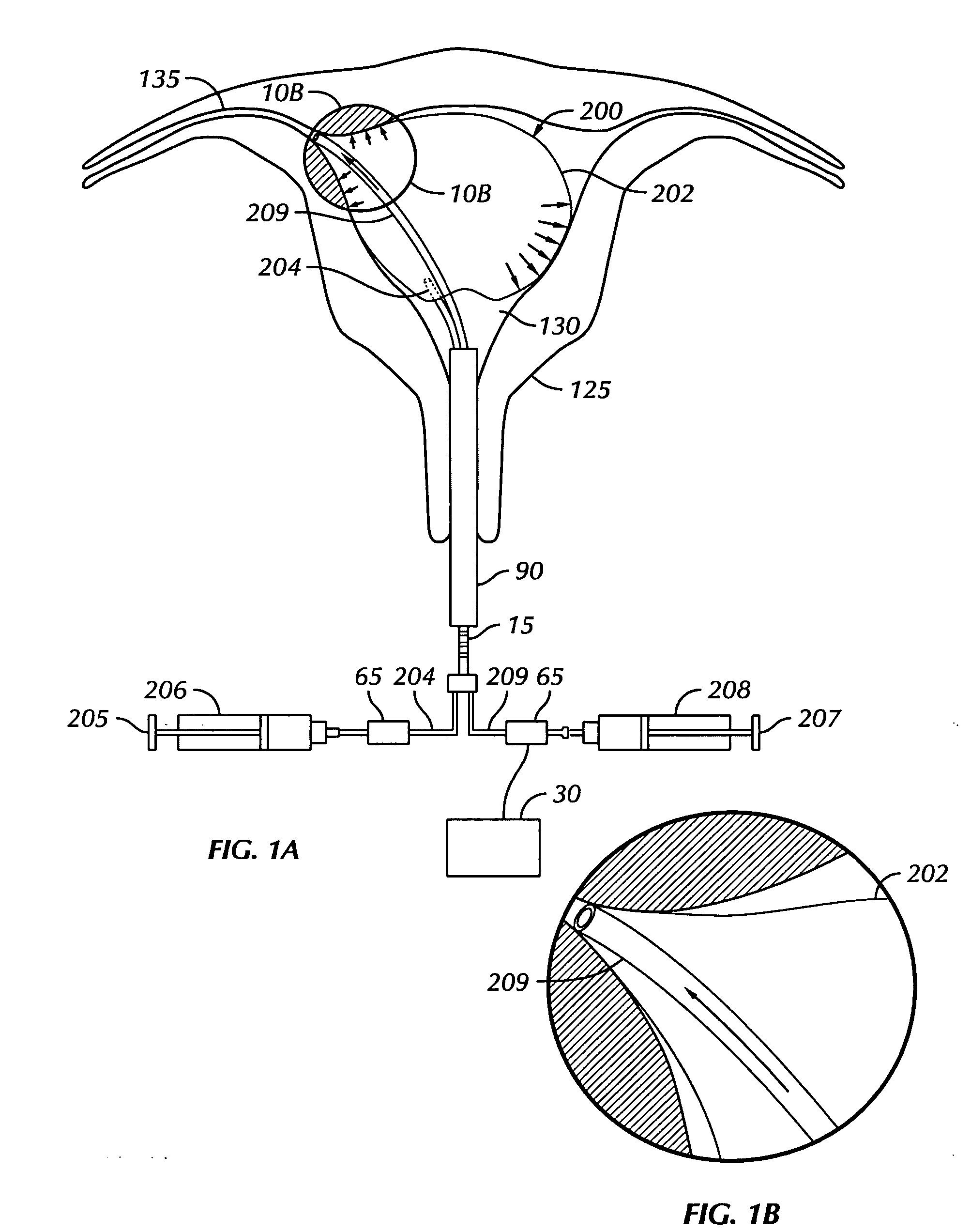 Apparatus and method for selectably treating a fallopian tube