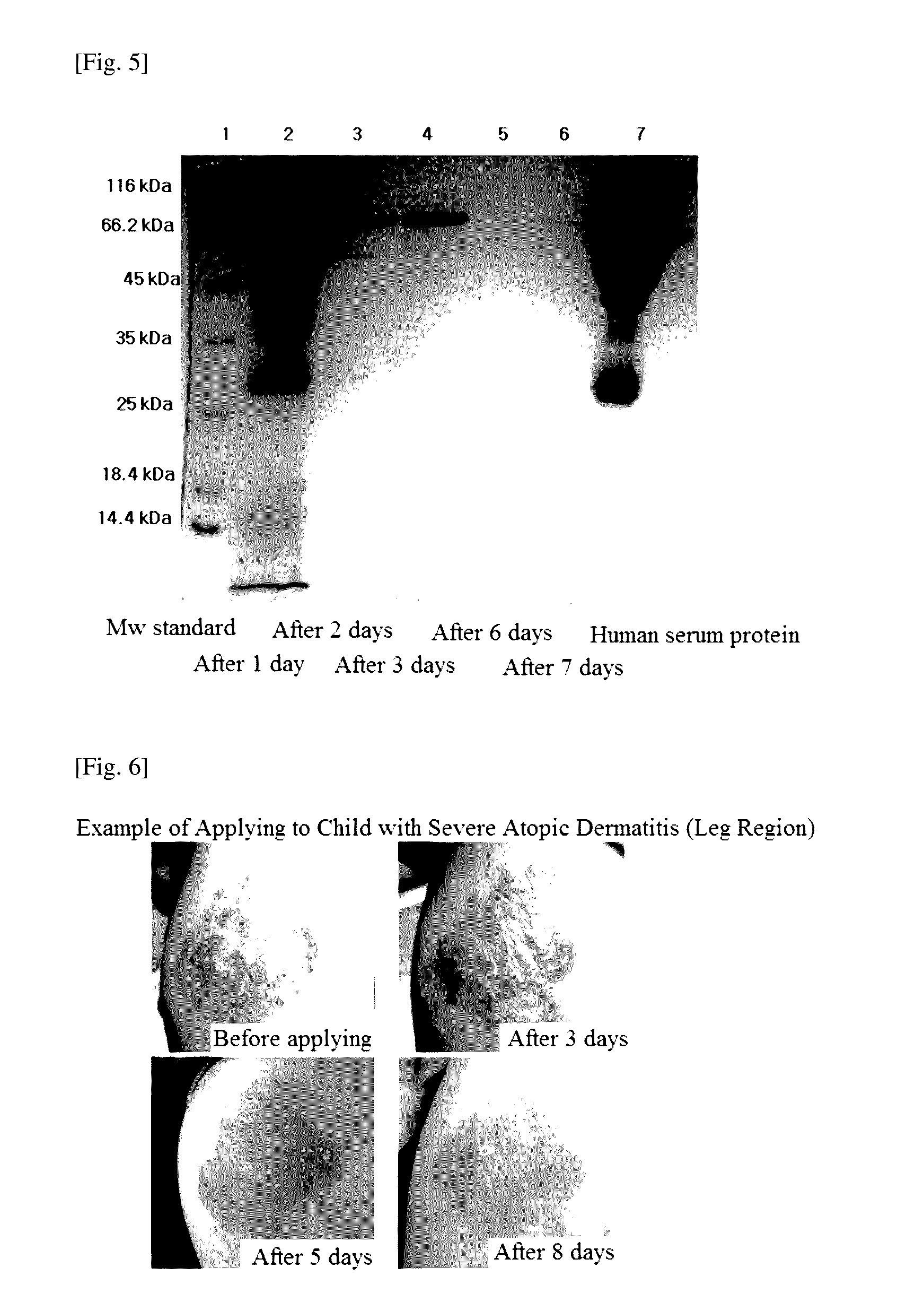 Patch for treating and alleviating symptoms of skin diseases accompanied by effusion of blood proteins