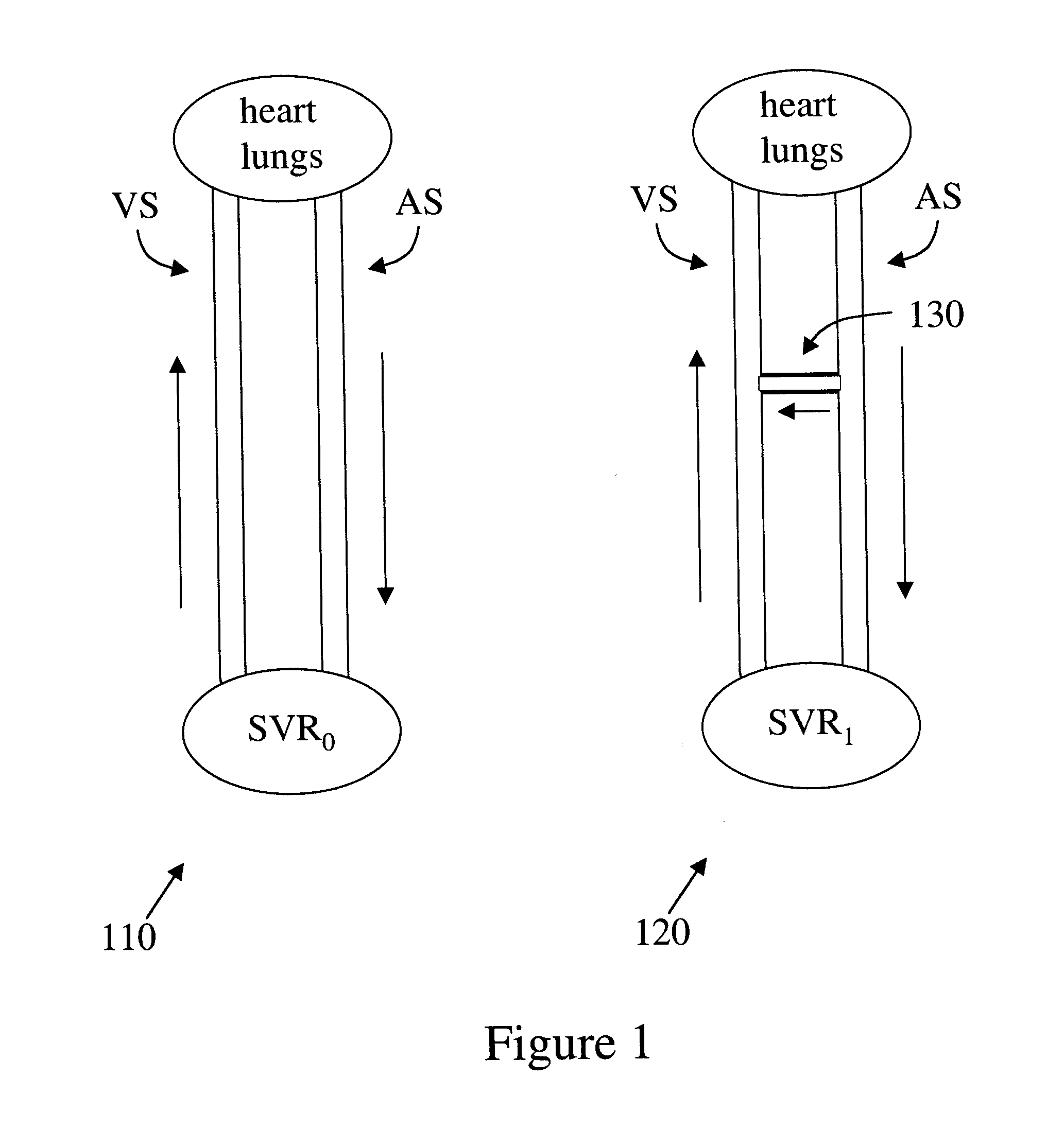 Implantable arterio-venous shunt devices and methods for their use