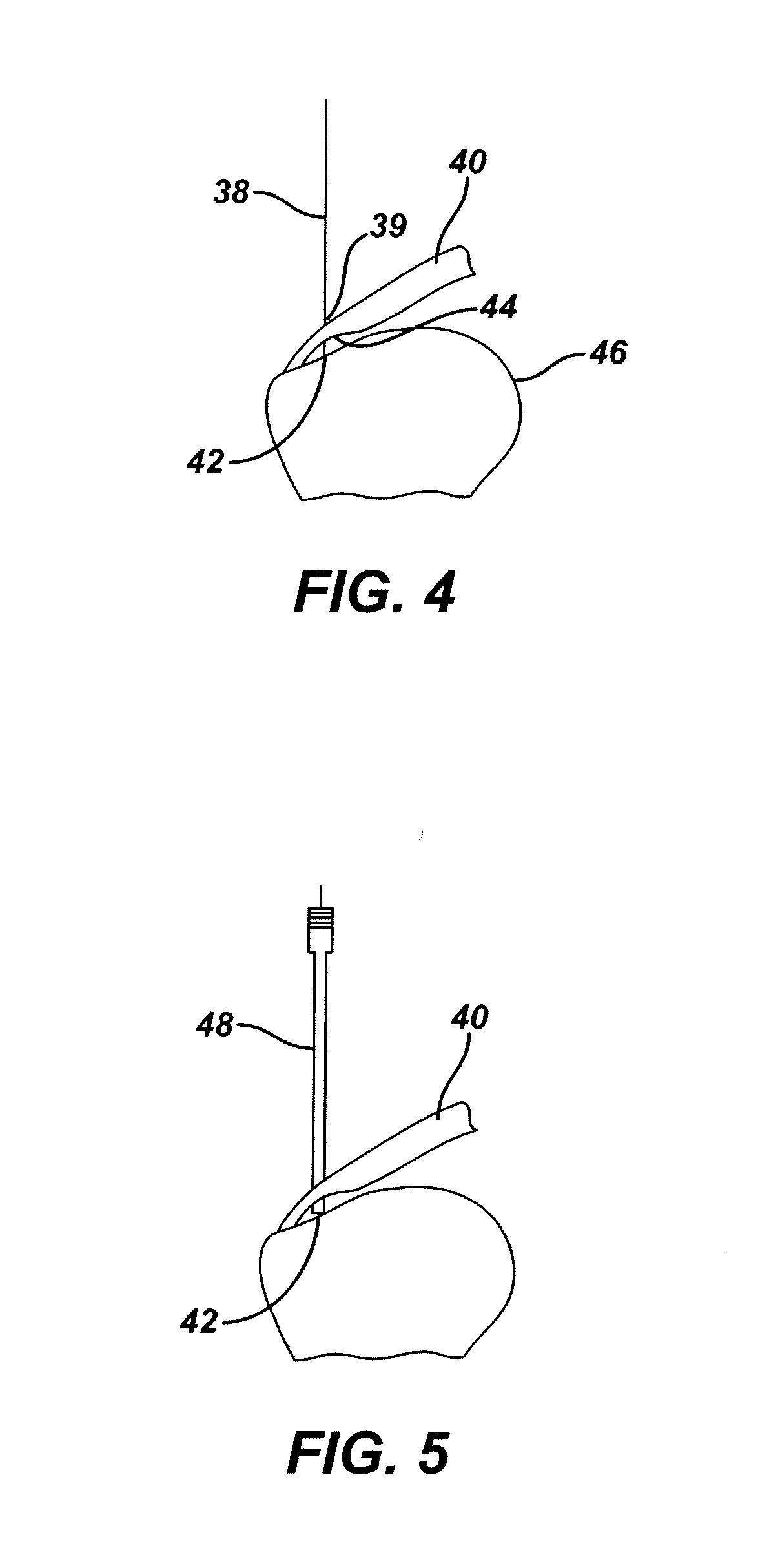 Partial thickness rotator cuff repair system and method