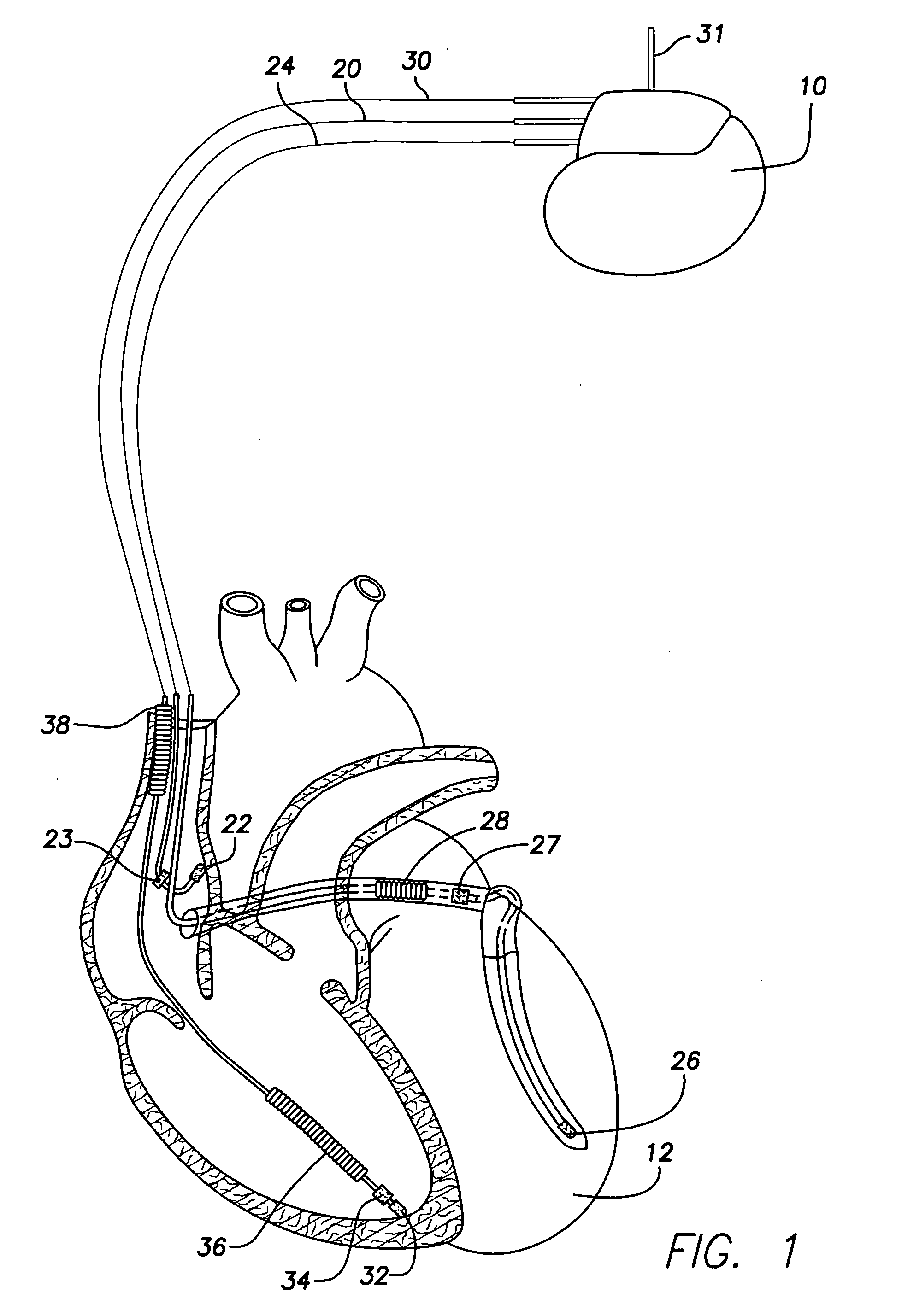 System and method for distinguishing between hypoglycemia and hyperglycemia using an implantable medical device
