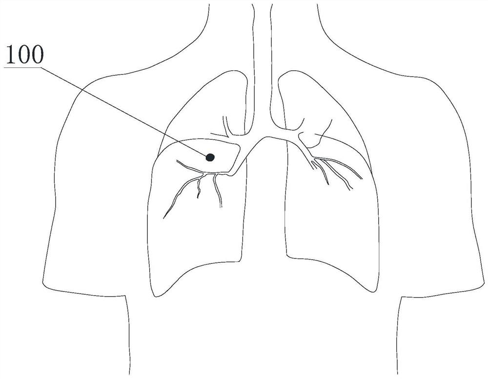 Method for positioning pulmonary nodules