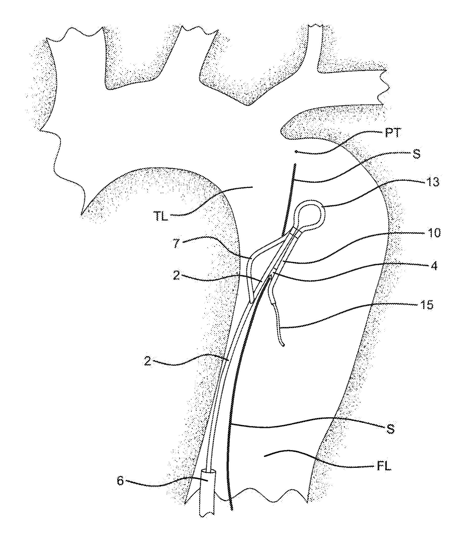 Method of using an aortic dissection septal cutting tool
