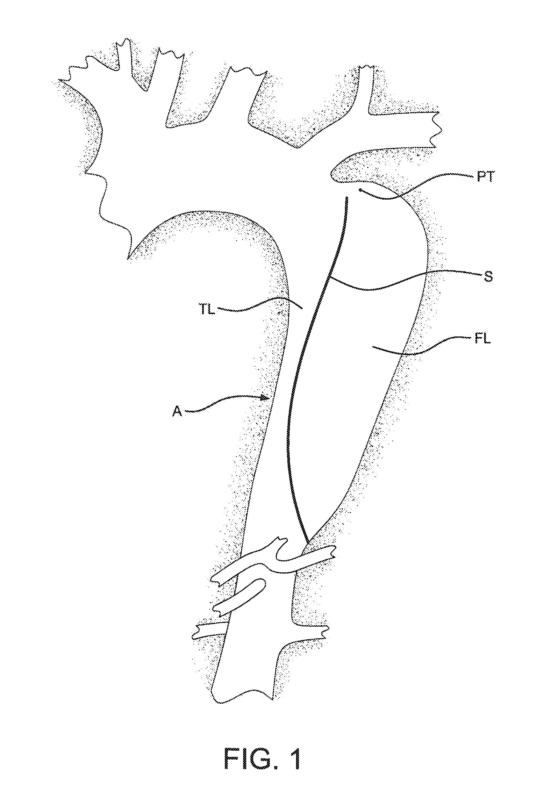 Method of using an aortic dissection septal cutting tool