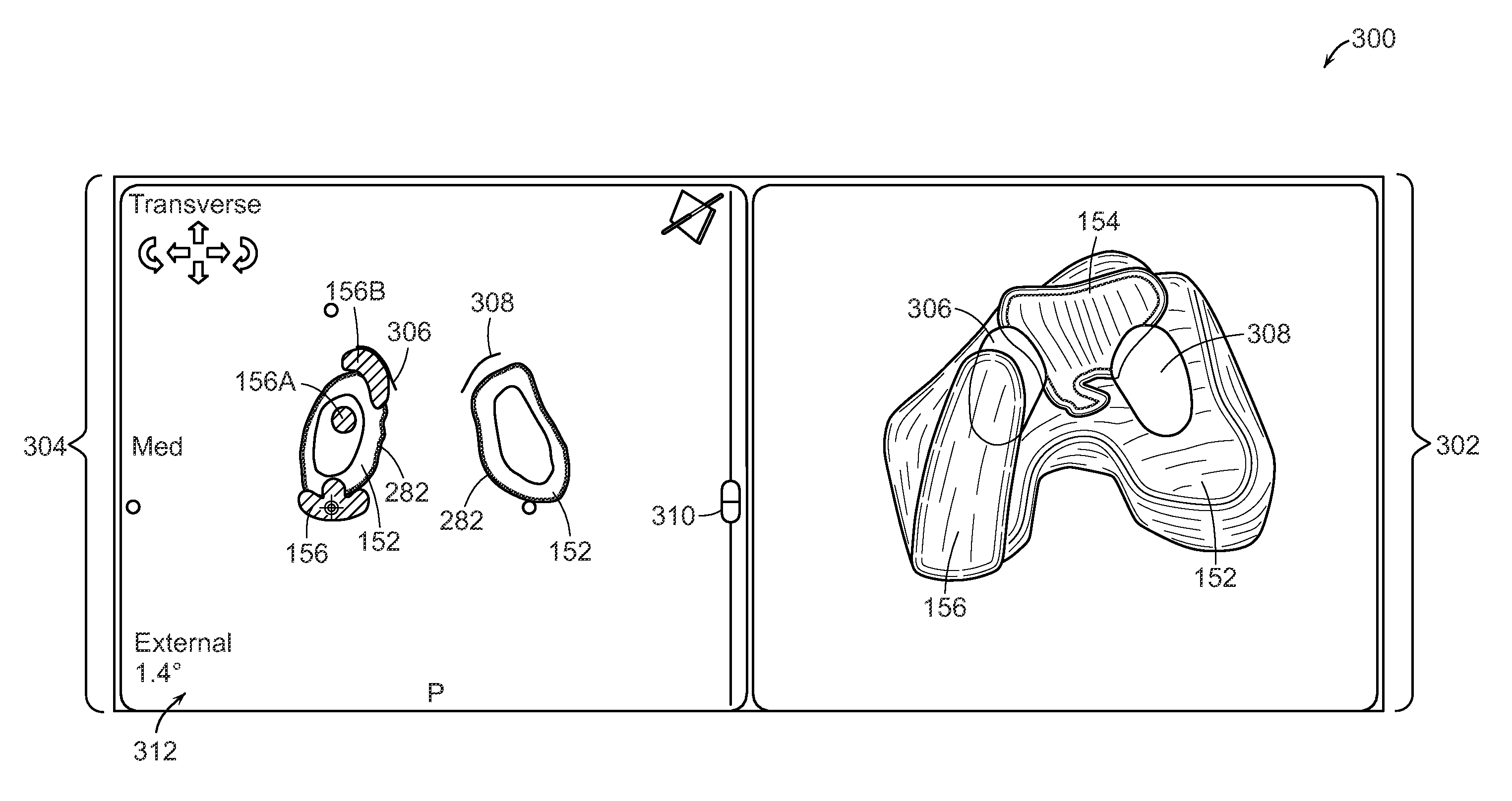 Implant planning for multiple implant components using constraints