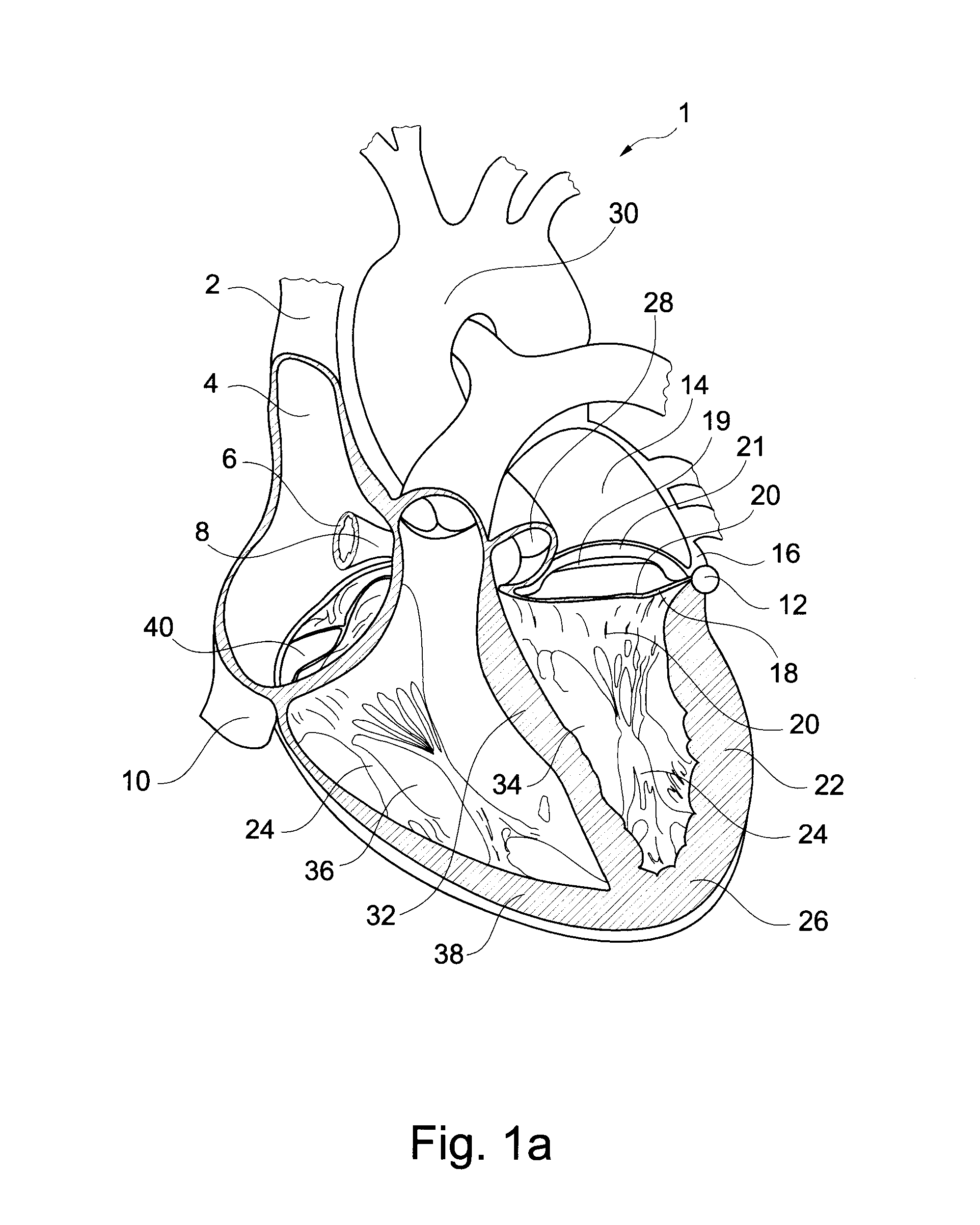 Left Heart Assist Device and Method