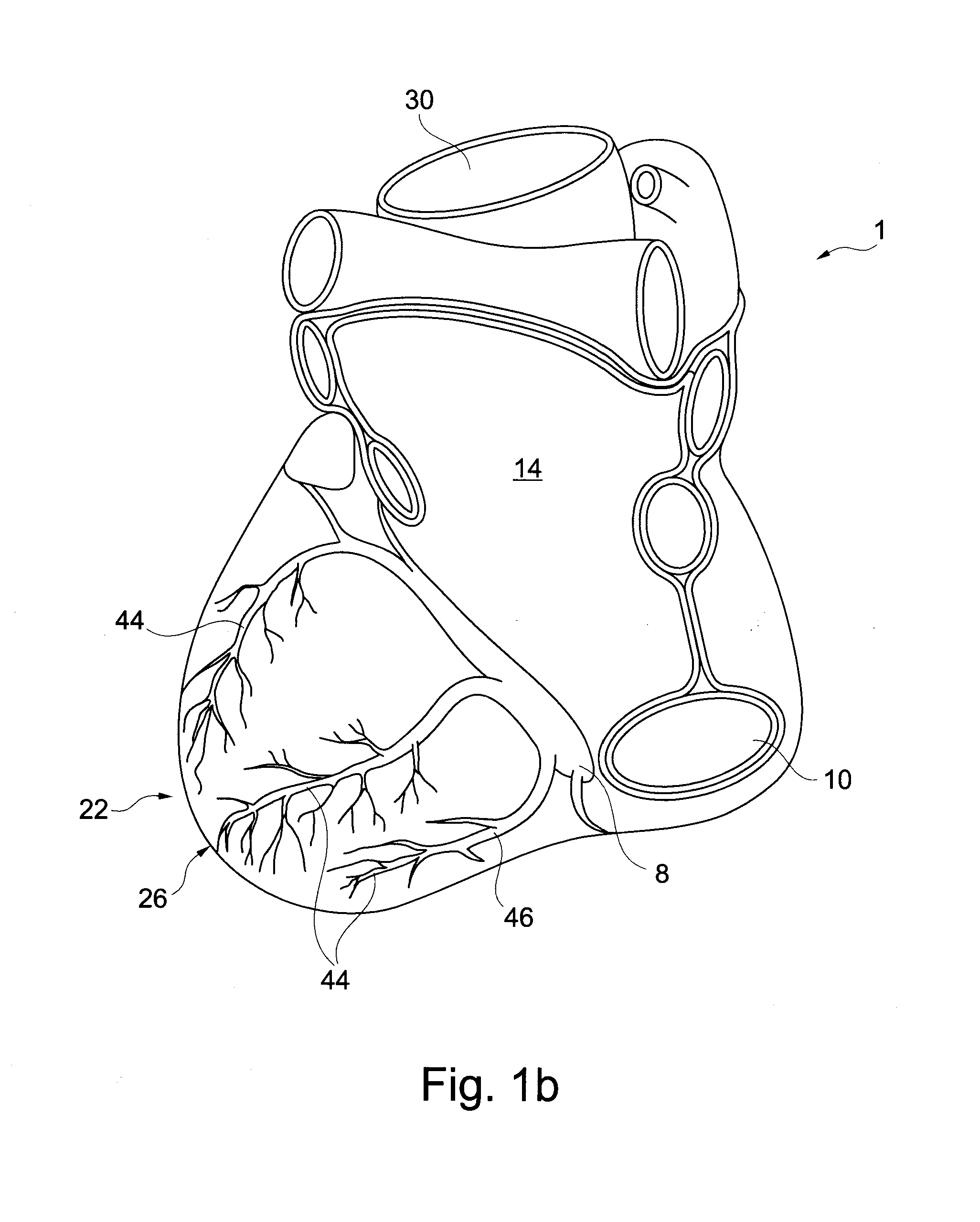 Left Heart Assist Device and Method