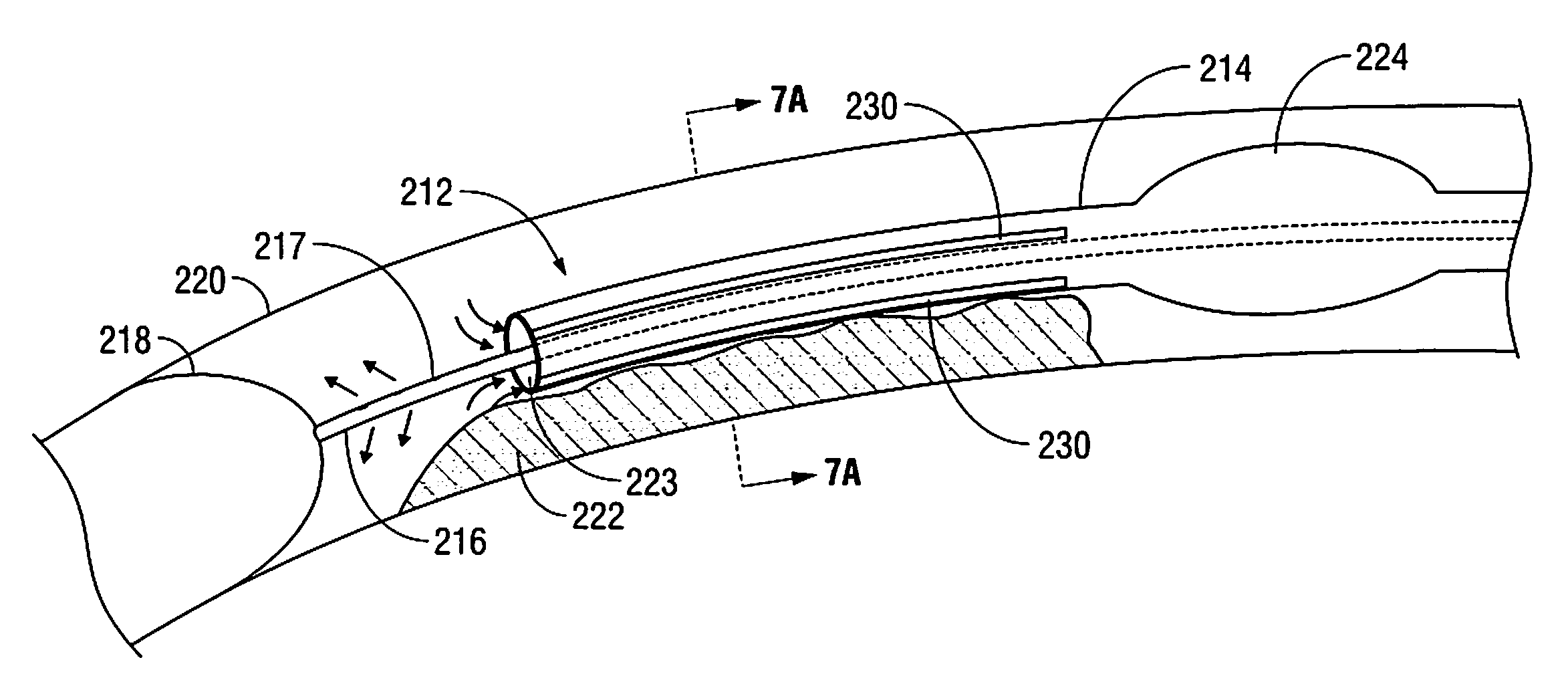 Endovascular Tissue Removal Device
