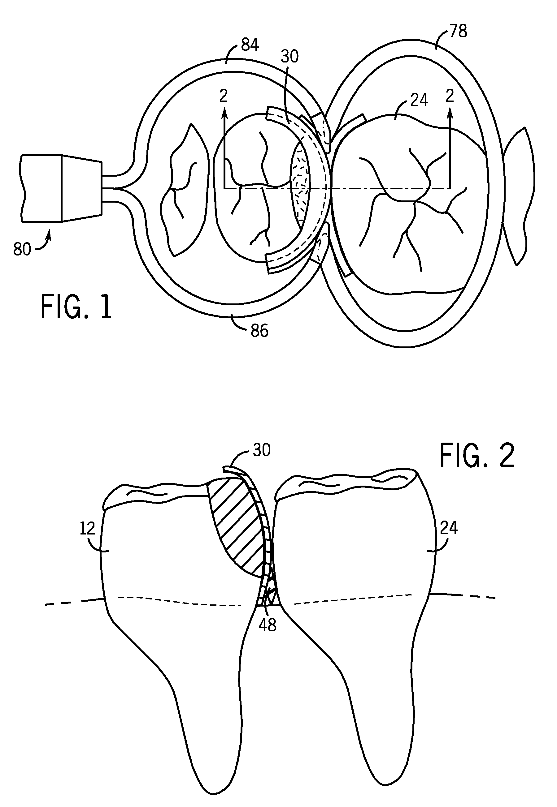 Dental Matrix Devices And A Seamless, Single Load Cavity Preparation And Filling Technique