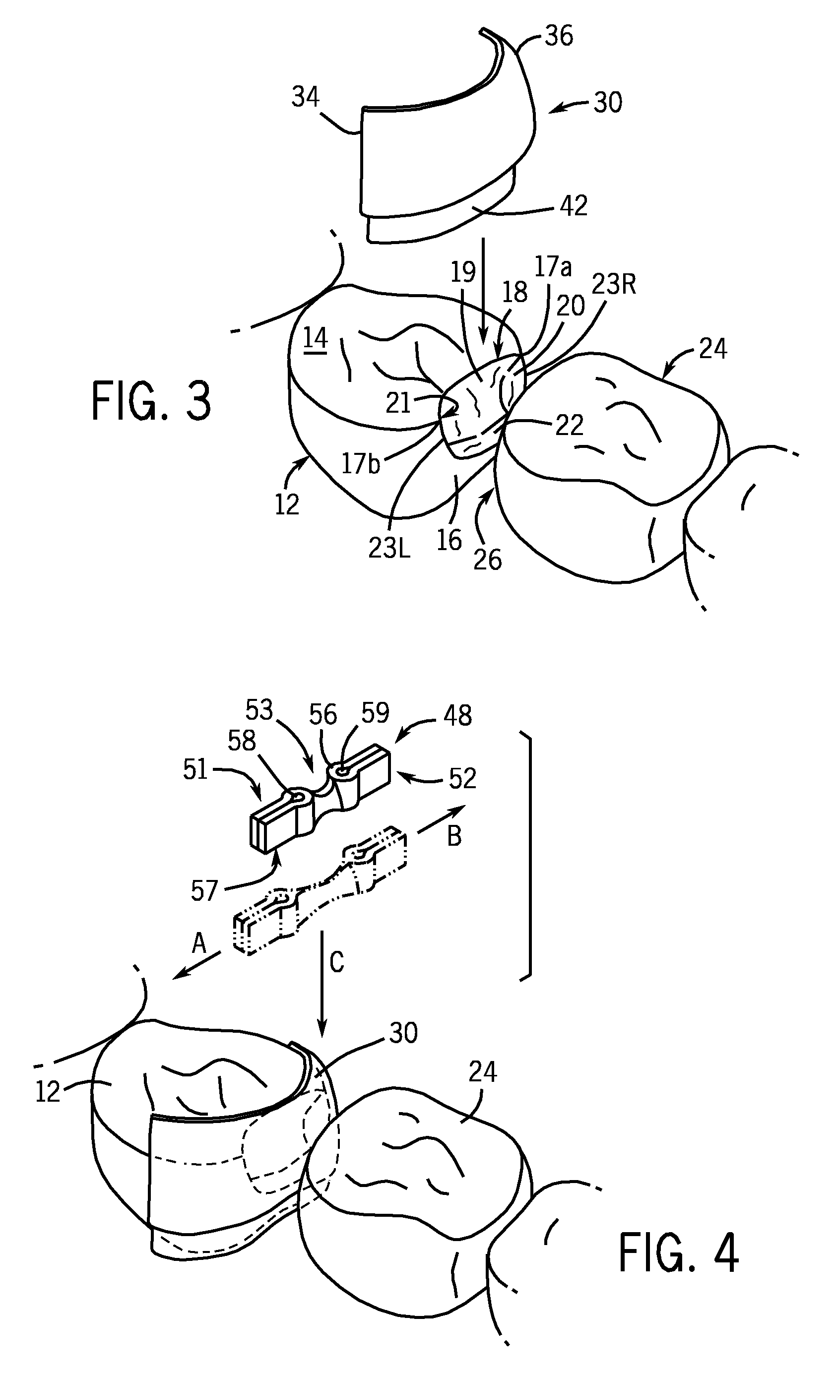 Dental Matrix Devices And A Seamless, Single Load Cavity Preparation And Filling Technique