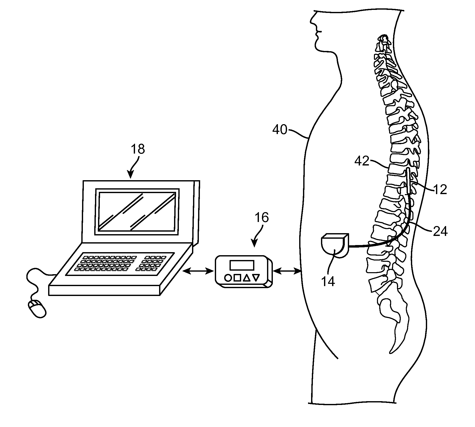 System and method for spinal cord stimulation to treat motor disorders