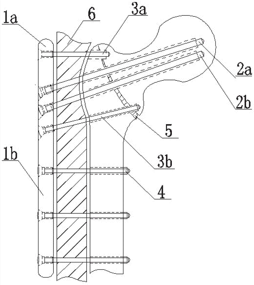 External fixing and locking nail plate system for treating femoral intertrochanteric fracture