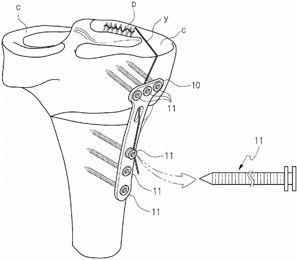 Fixing tool for open-wedge high tibial osteotomy