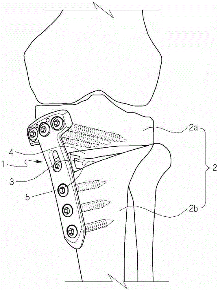 Fixing tool for open-wedge high tibial osteotomy