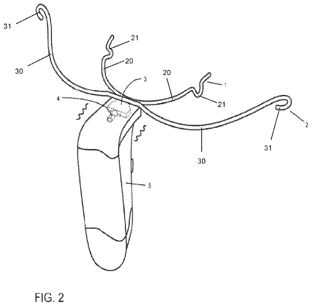 System and method of more directly vibrating an orthopedic-orthodontic device