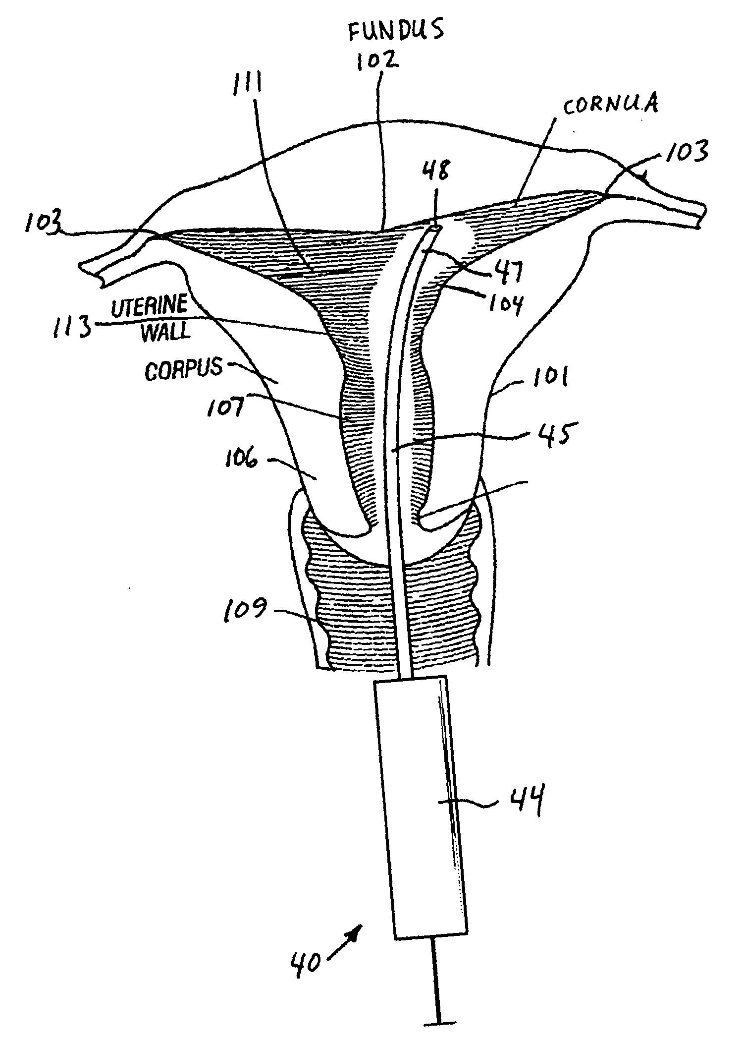 Method and apparatus for anesthetizing a uterus