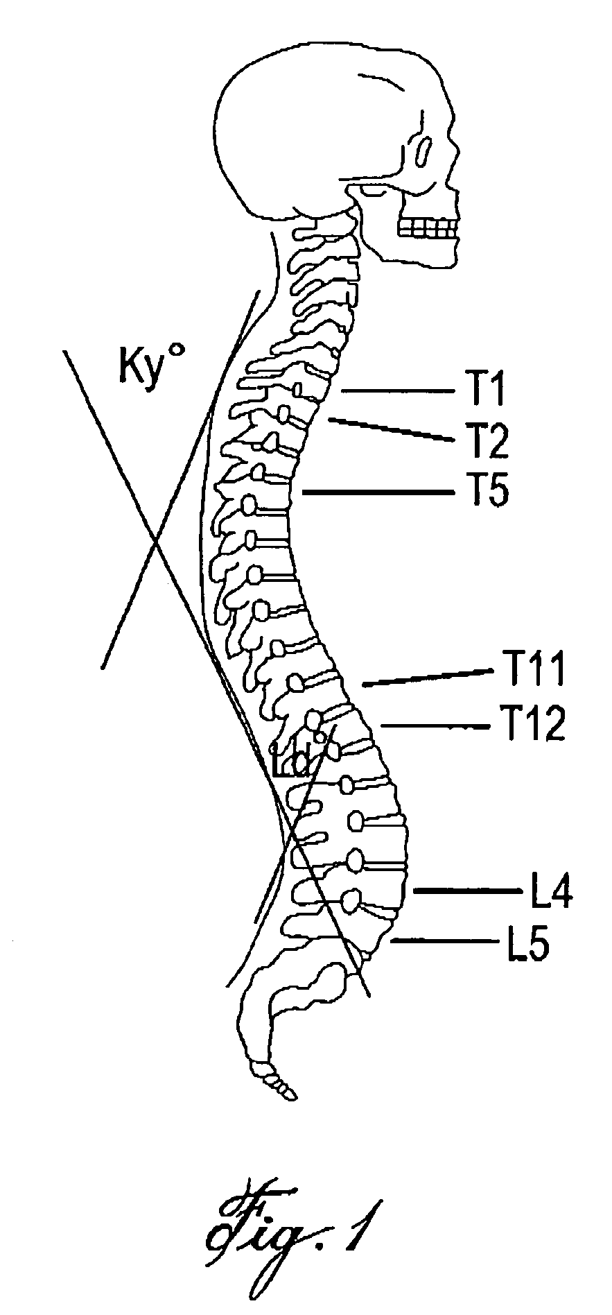 Method for determining the risk of developing a skeletal condition