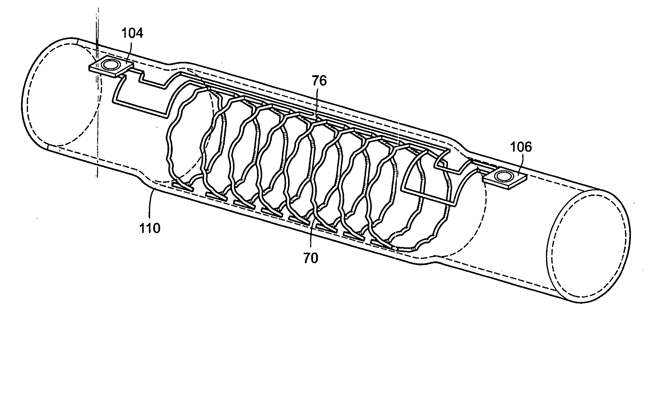 Antenna stent device for wireless, intraluminal monitoring