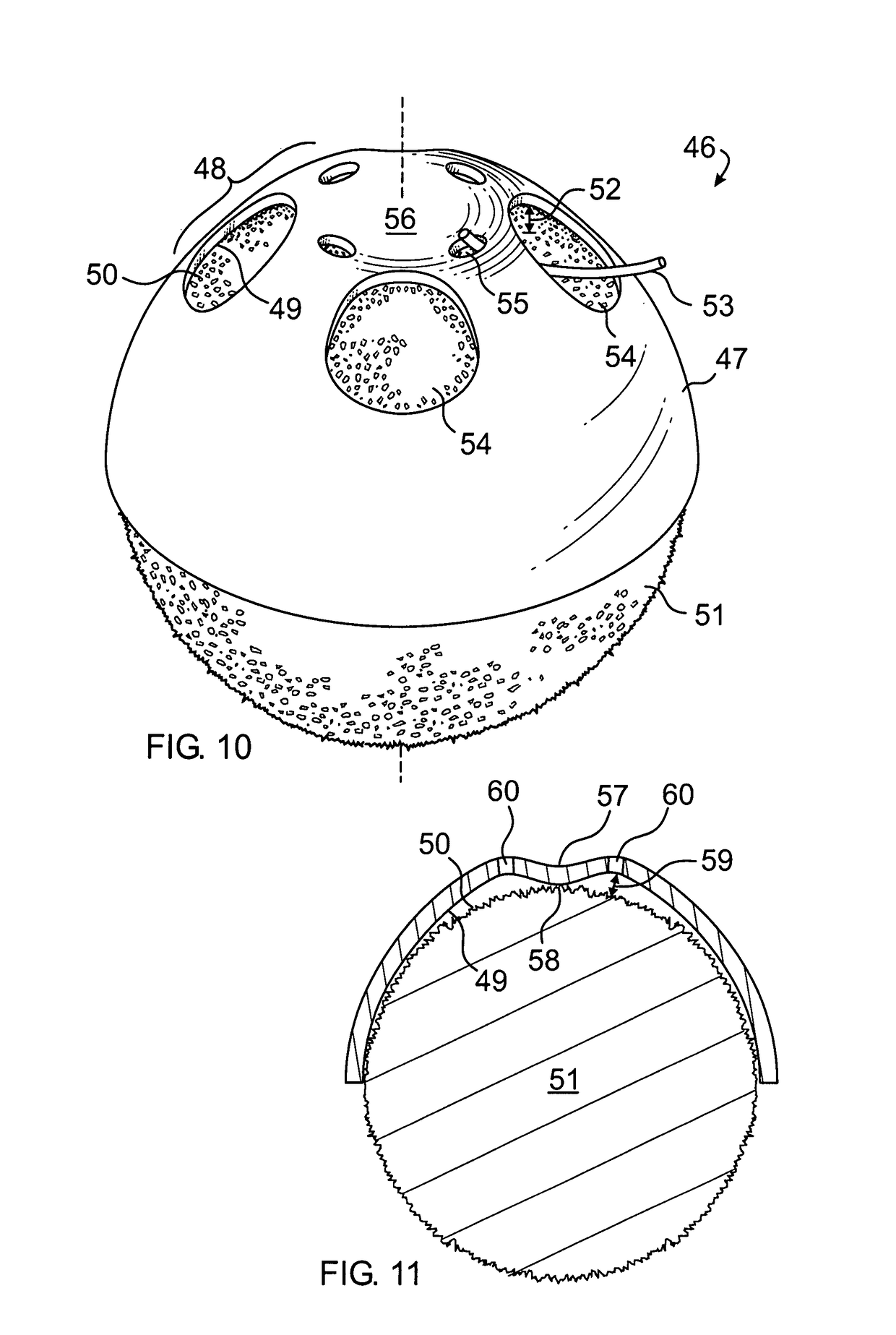 Orbital implant coating having bulbously raised suture zone