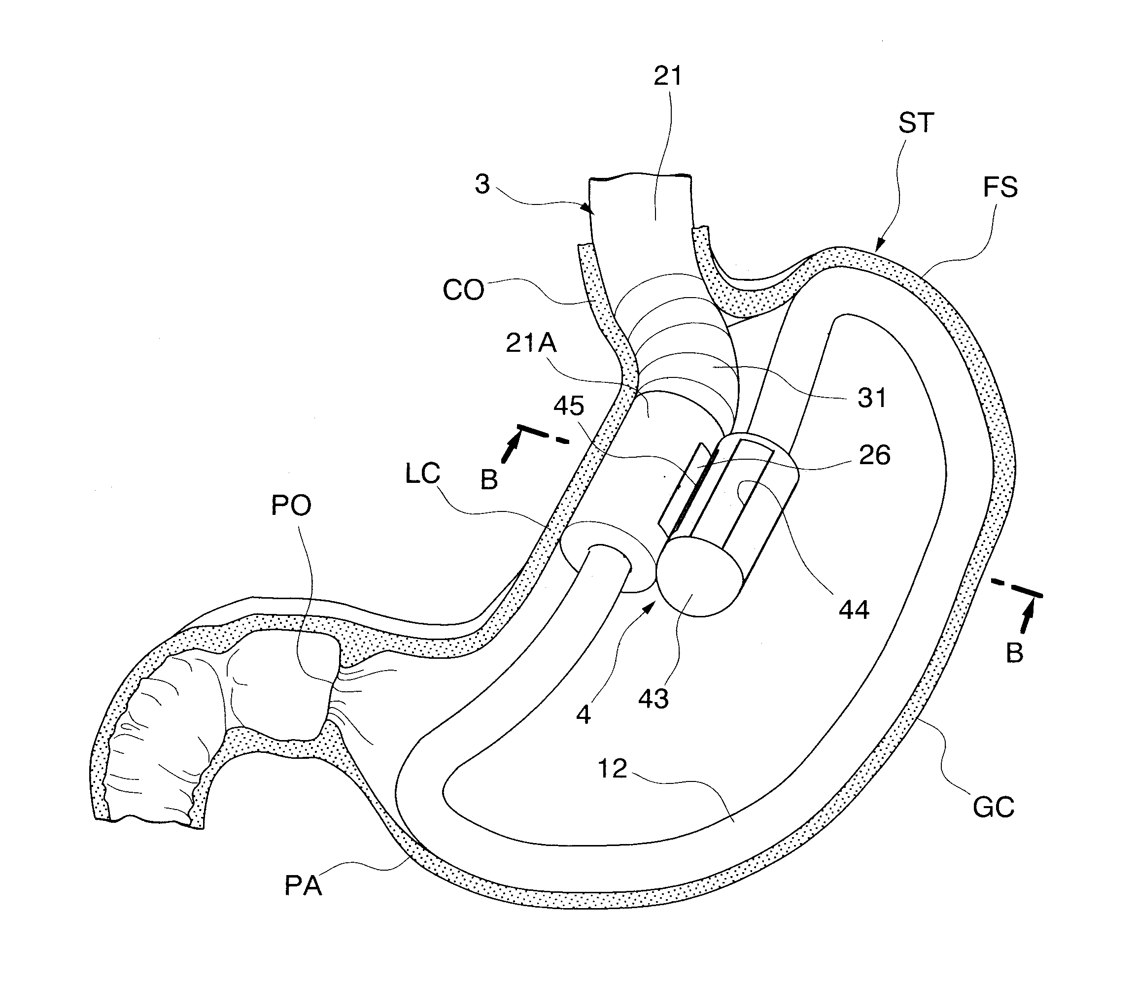 Gastric therapy system and method for suturing gastric wall