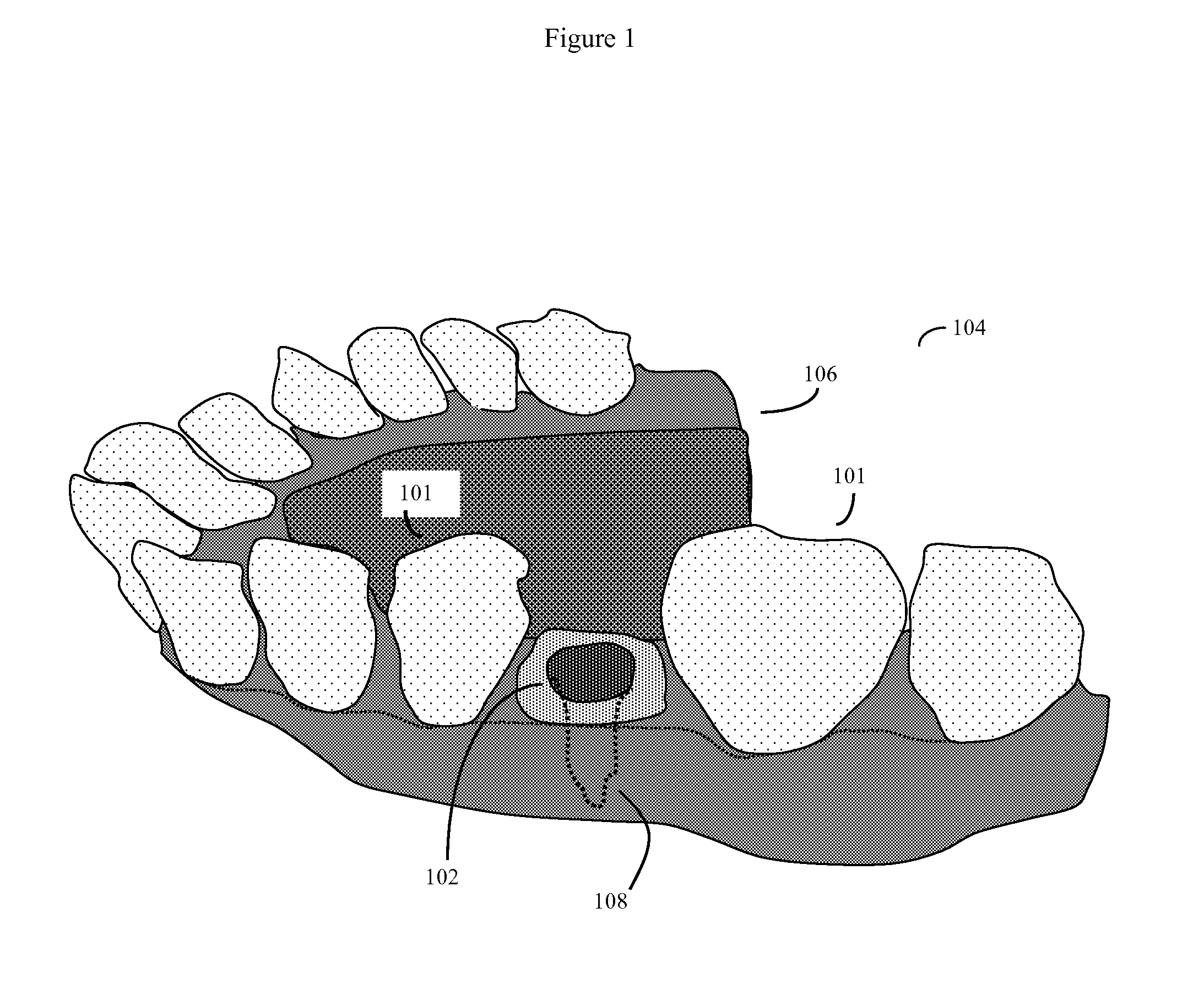 Method and kit for producing dental implant drilling guides
