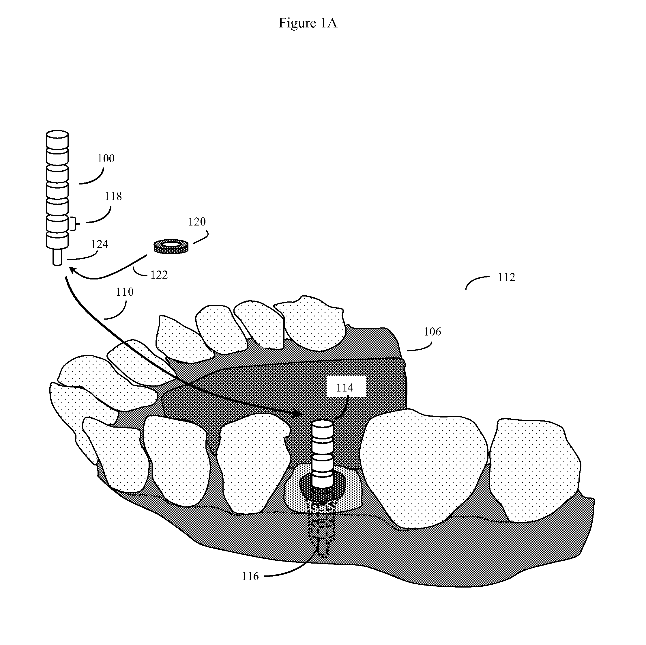 Method and kit for producing dental implant drilling guides