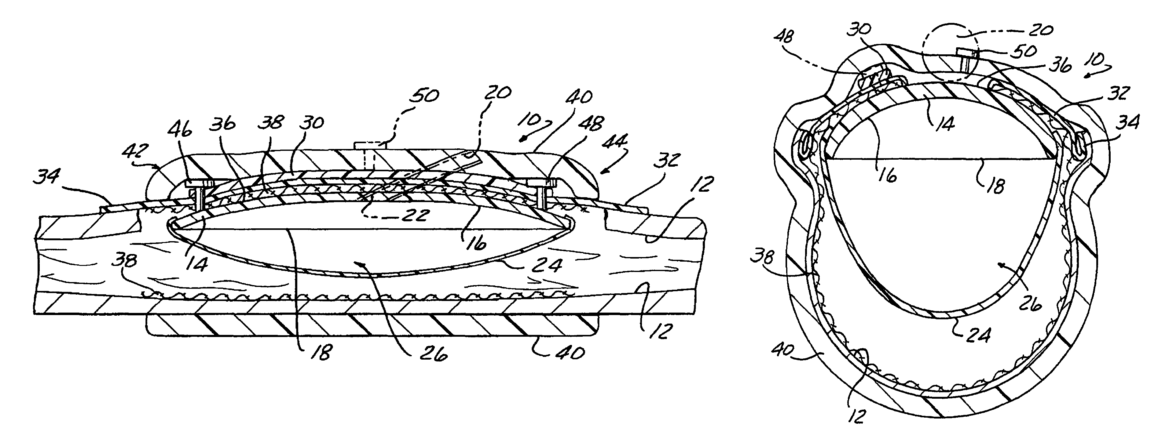 Stable aortic blood pump implant