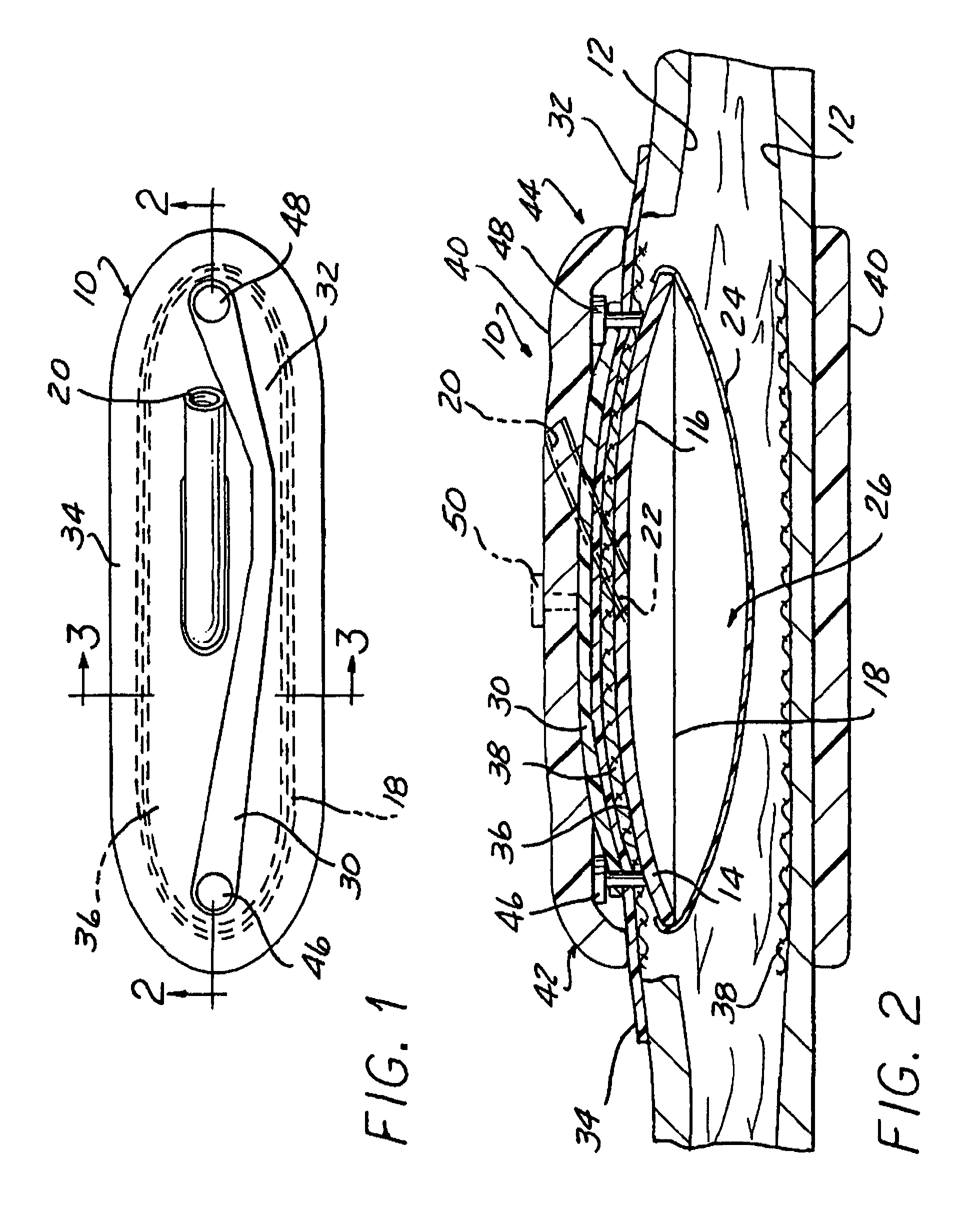 Stable aortic blood pump implant